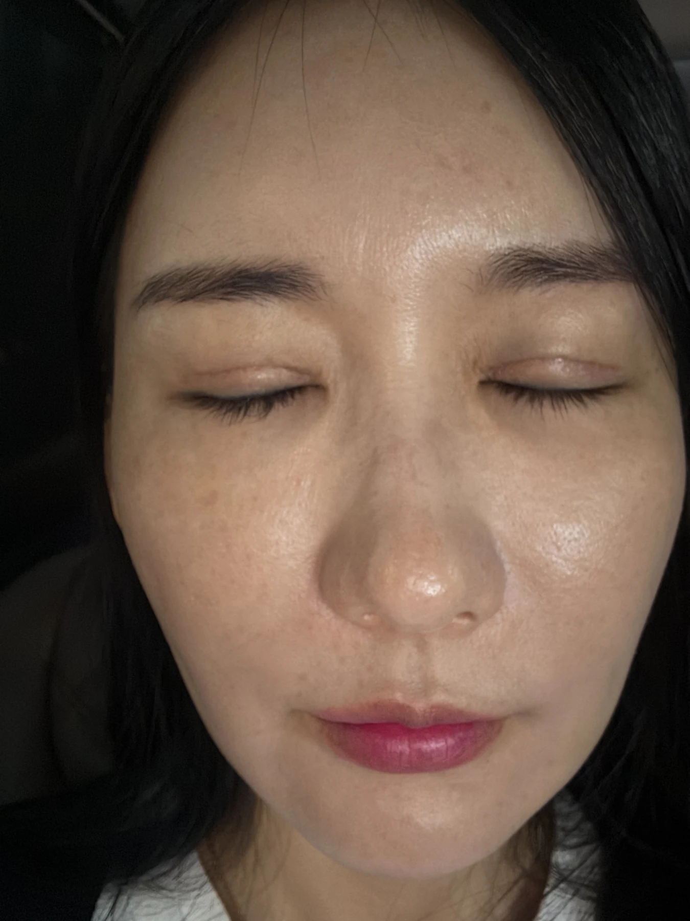 Incisional eyelid revision and eye-corner surgery: three-week recovery · Case 071 at Answer Plastic Surgery. Closed-eyelid view — 3 weeks after surgery, incisional eyelid revision and eye-corner surgery at Answer Plastic Surgery (case 071).