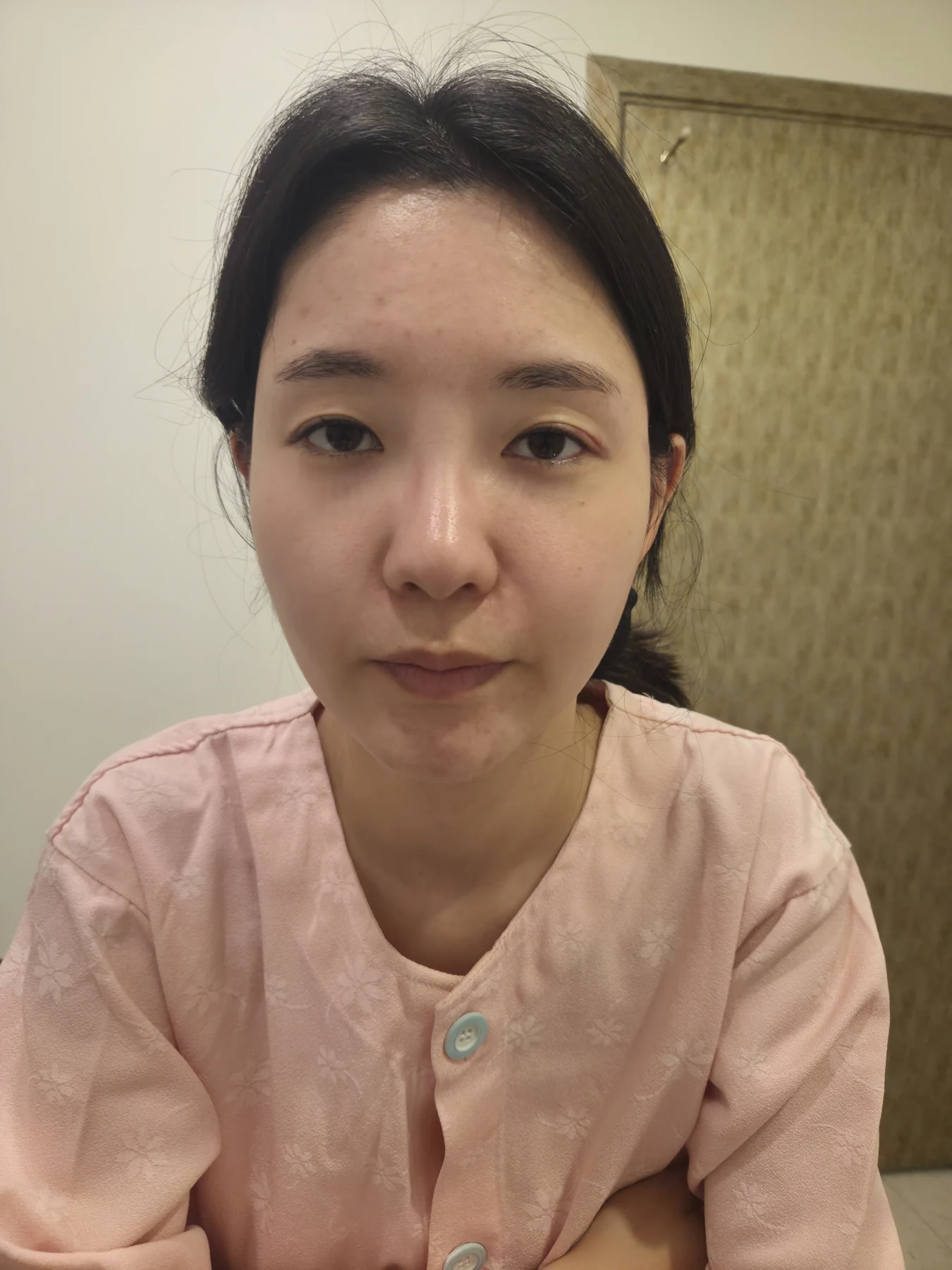 Eye surgery: before photographs and one-month follow-up · Case 072 at Answer Plastic Surgery. Front view — before, eye surgery at Answer Plastic Surgery (case 072).