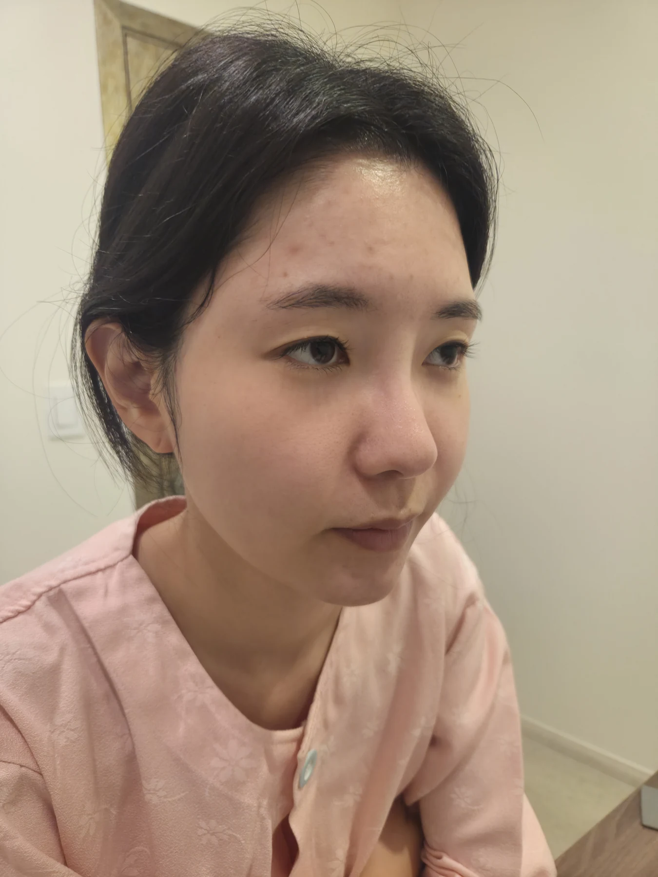 Eye surgery: before photographs and one-month follow-up · Case 072 at Answer Plastic Surgery. Oblique view — before, eye surgery at Answer Plastic Surgery (case 072).