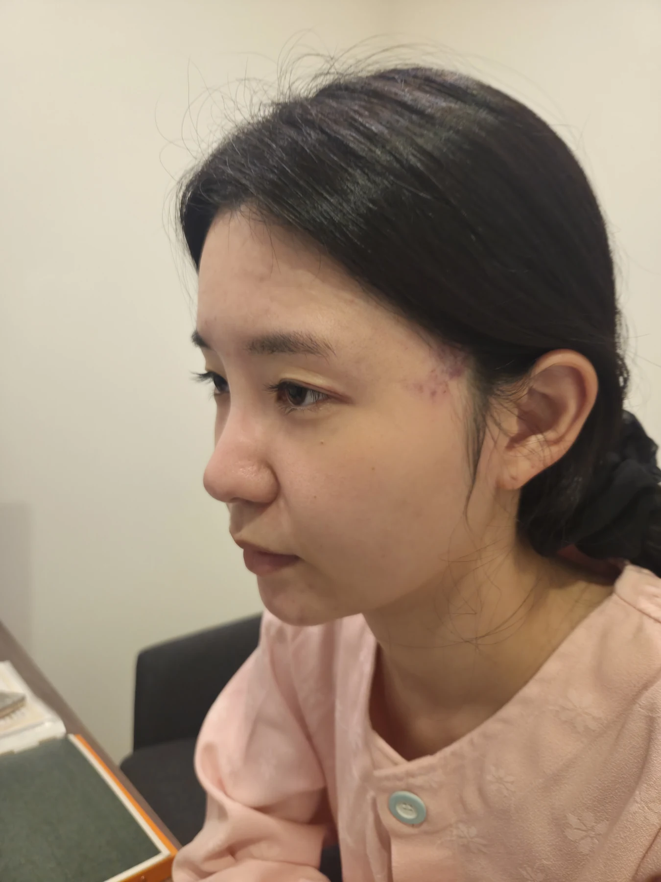 Eye surgery: before photographs and one-month follow-up · Case 072 at Answer Plastic Surgery. Opposite oblique view — before, eye surgery at Answer Plastic Surgery (case 072).