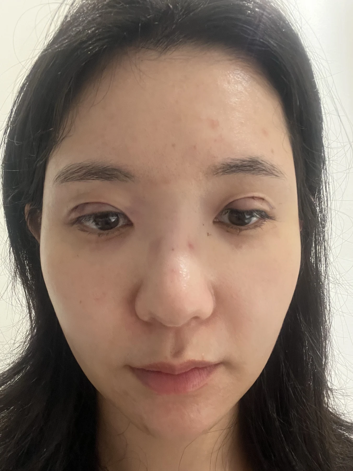 Eye surgery: before photographs and one-month follow-up · Case 072 at Answer Plastic Surgery. Front view — surgery day, eye surgery at Answer Plastic Surgery (case 072).