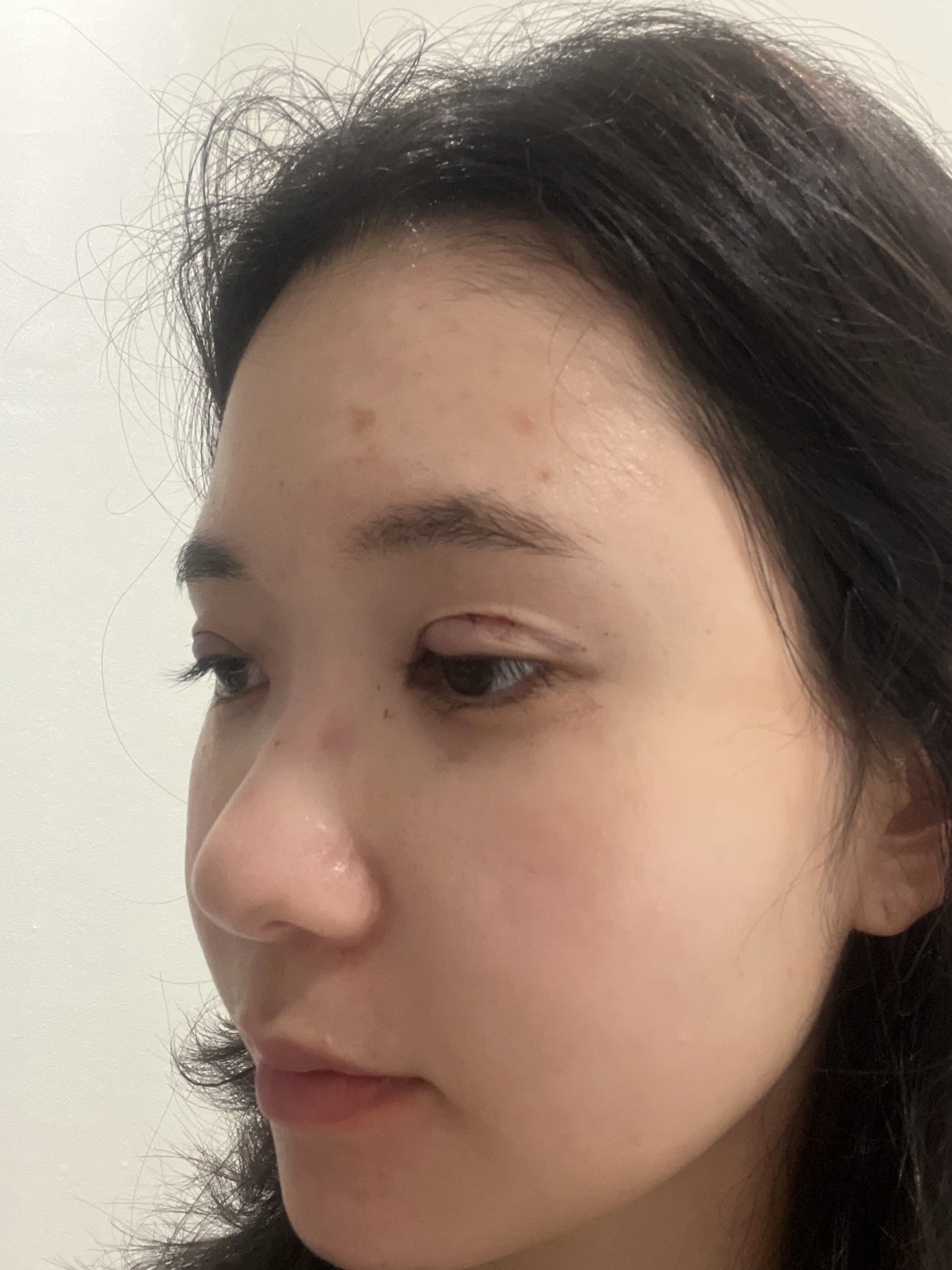 Eye surgery: before photographs and one-month follow-up · Case 072 at Answer Plastic Surgery. Oblique view — surgery day, eye surgery at Answer Plastic Surgery (case 072).