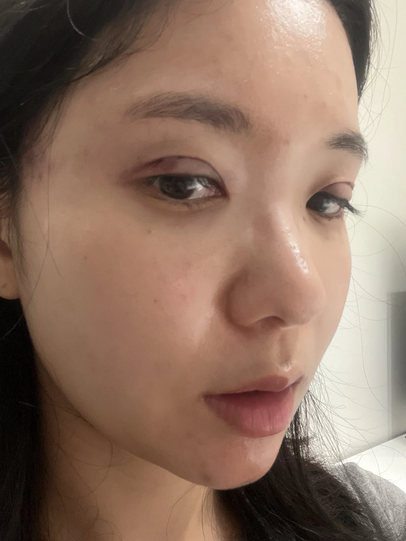 Eye surgery: before photographs and one-month follow-up · Case 072 at Answer Plastic Surgery. Opposite oblique view — surgery day, eye surgery at Answer Plastic Surgery (case 072).