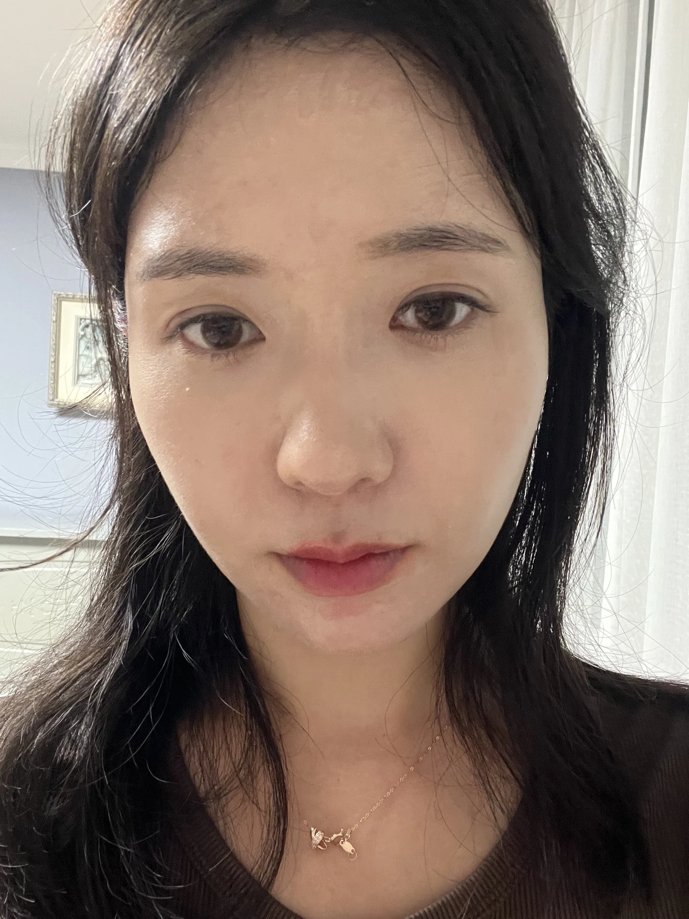 Eye surgery: before photographs and one-month follow-up · Case 072 at Answer Plastic Surgery. Front view — 2 weeks after surgery, eye surgery at Answer Plastic Surgery (case 072).