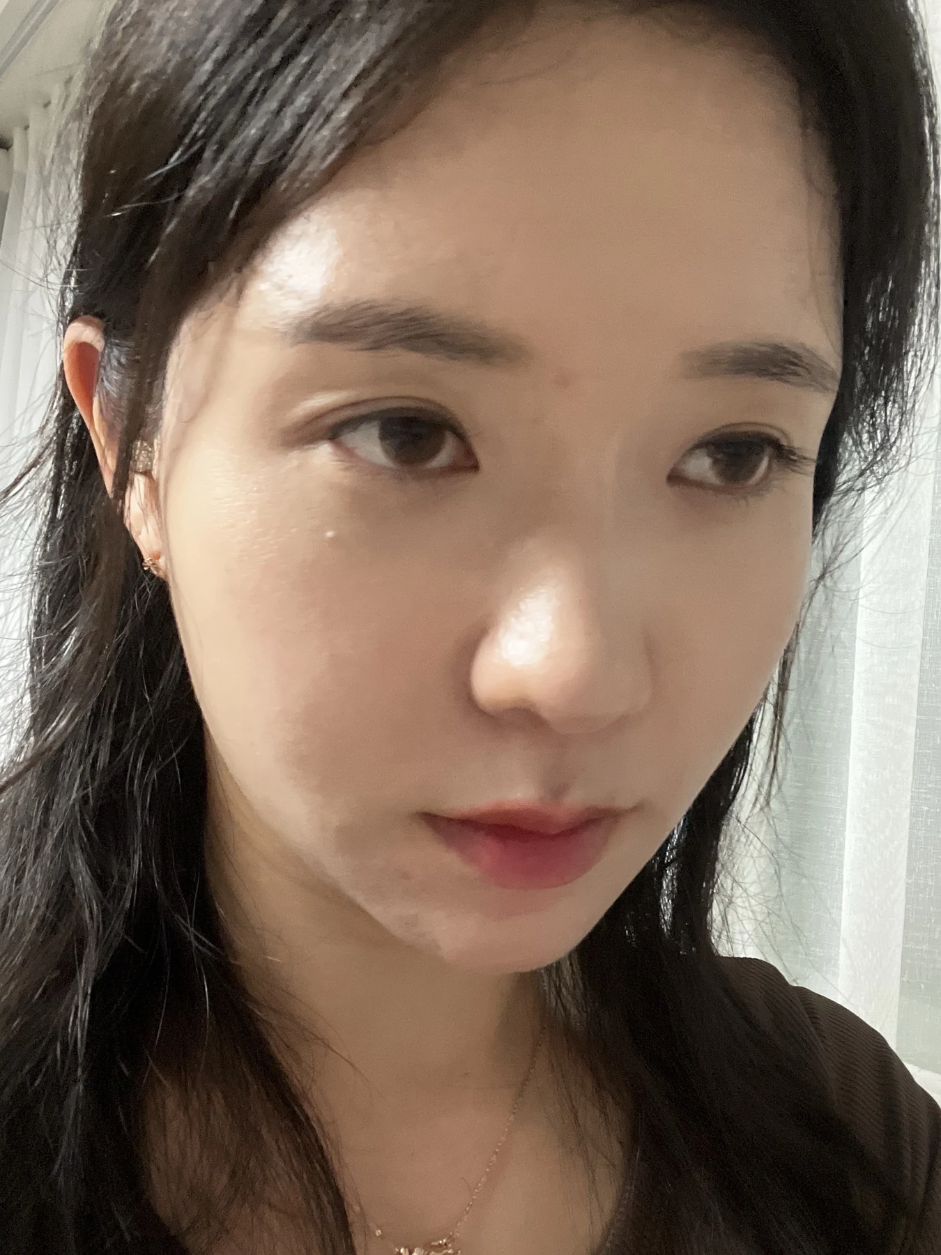 Eye surgery: before photographs and one-month follow-up · Case 072 at Answer Plastic Surgery. Oblique view — 2 weeks after surgery, eye surgery at Answer Plastic Surgery (case 072).