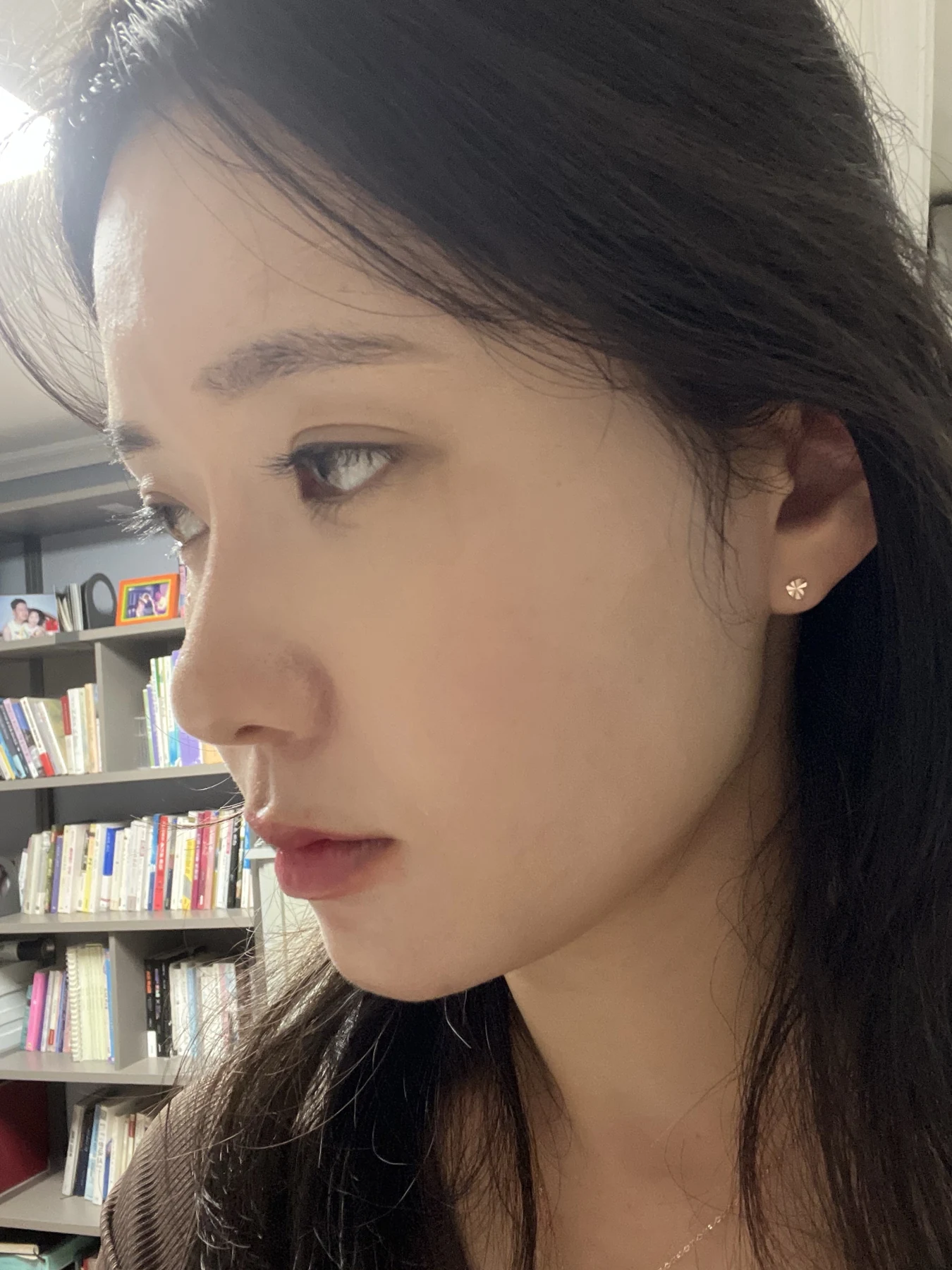 Eye surgery: before photographs and one-month follow-up · Case 072 at Answer Plastic Surgery. Opposite oblique view — 2 weeks after surgery, eye surgery at Answer Plastic Surgery (case 072).