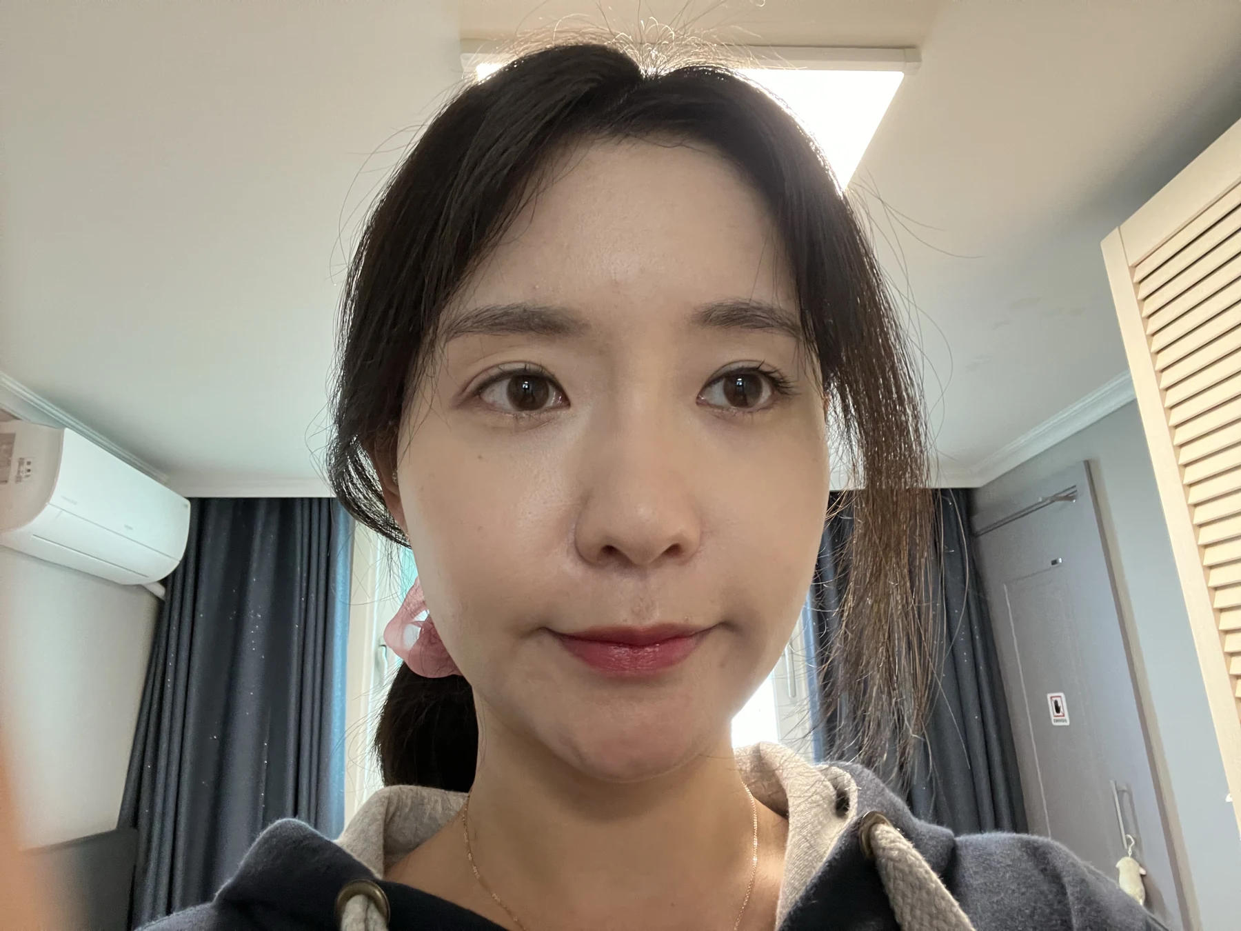 Eye surgery: before photographs and one-month follow-up · Case 072 at Answer Plastic Surgery. Front portrait — 1 month after surgery, eye surgery at Answer Plastic Surgery (case 072).