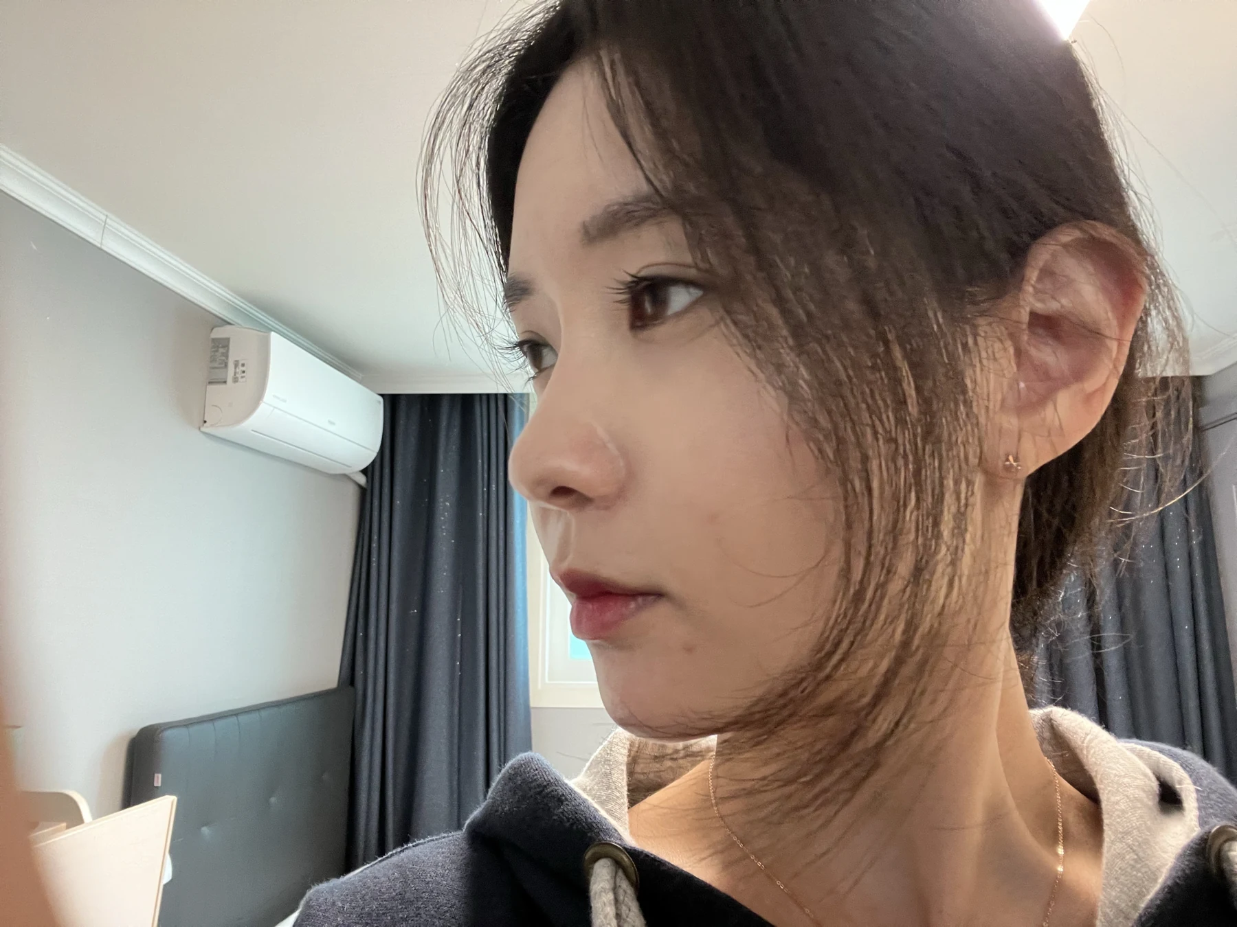 Eye surgery: before photographs and one-month follow-up · Case 072 at Answer Plastic Surgery. Side view — 1 month after surgery, eye surgery at Answer Plastic Surgery (case 072).