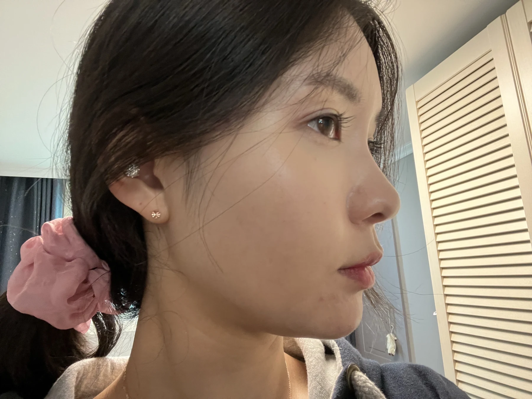 Eye surgery: before photographs and one-month follow-up · Case 072 at Answer Plastic Surgery. Opposite side view — 1 month after surgery, eye surgery at Answer Plastic Surgery (case 072).