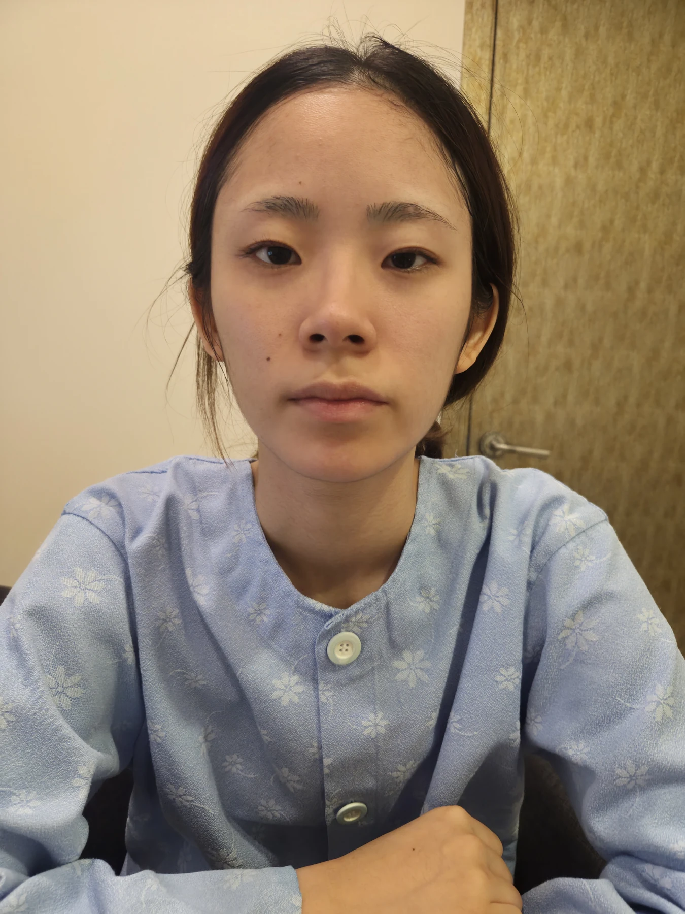 Inner and outer eye-corner surgery: recovery through three months · Case 073 at Answer Plastic Surgery. Front view — before surgery, inner and outer eye-corner surgery at Answer Plastic Surgery (case 073).