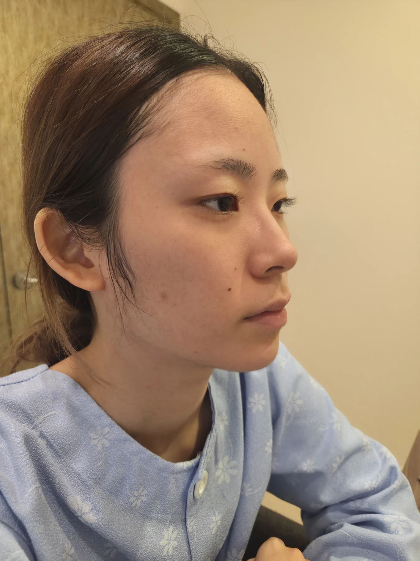 Inner and outer eye-corner surgery: recovery through three months · Case 073 at Answer Plastic Surgery. Oblique view facing image right — before surgery, inner and outer eye-corner surgery at Answer Plastic Surgery (case 073).