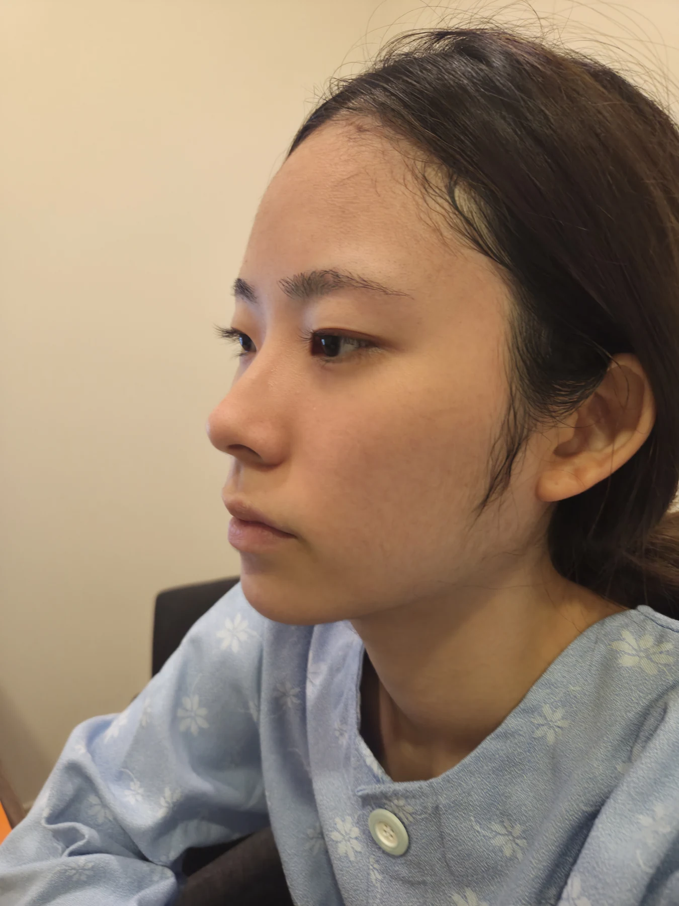 Inner and outer eye-corner surgery: recovery through three months · Case 073 at Answer Plastic Surgery. Oblique view facing image left — before surgery, inner and outer eye-corner surgery at Answer Plastic Surgery (case 073).