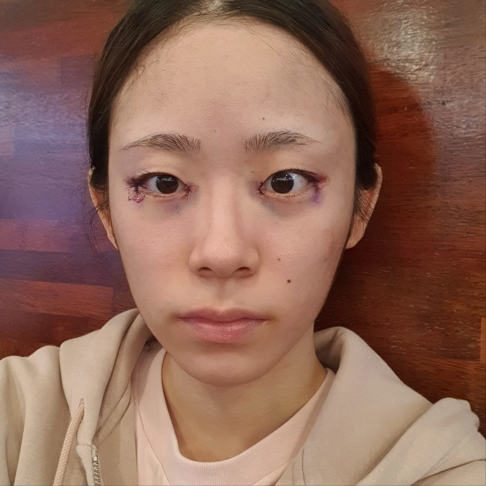 Inner and outer eye-corner surgery: recovery through three months · Case 073 at Answer Plastic Surgery. Front view — surgery day, inner and outer eye-corner surgery at Answer Plastic Surgery (case 073).