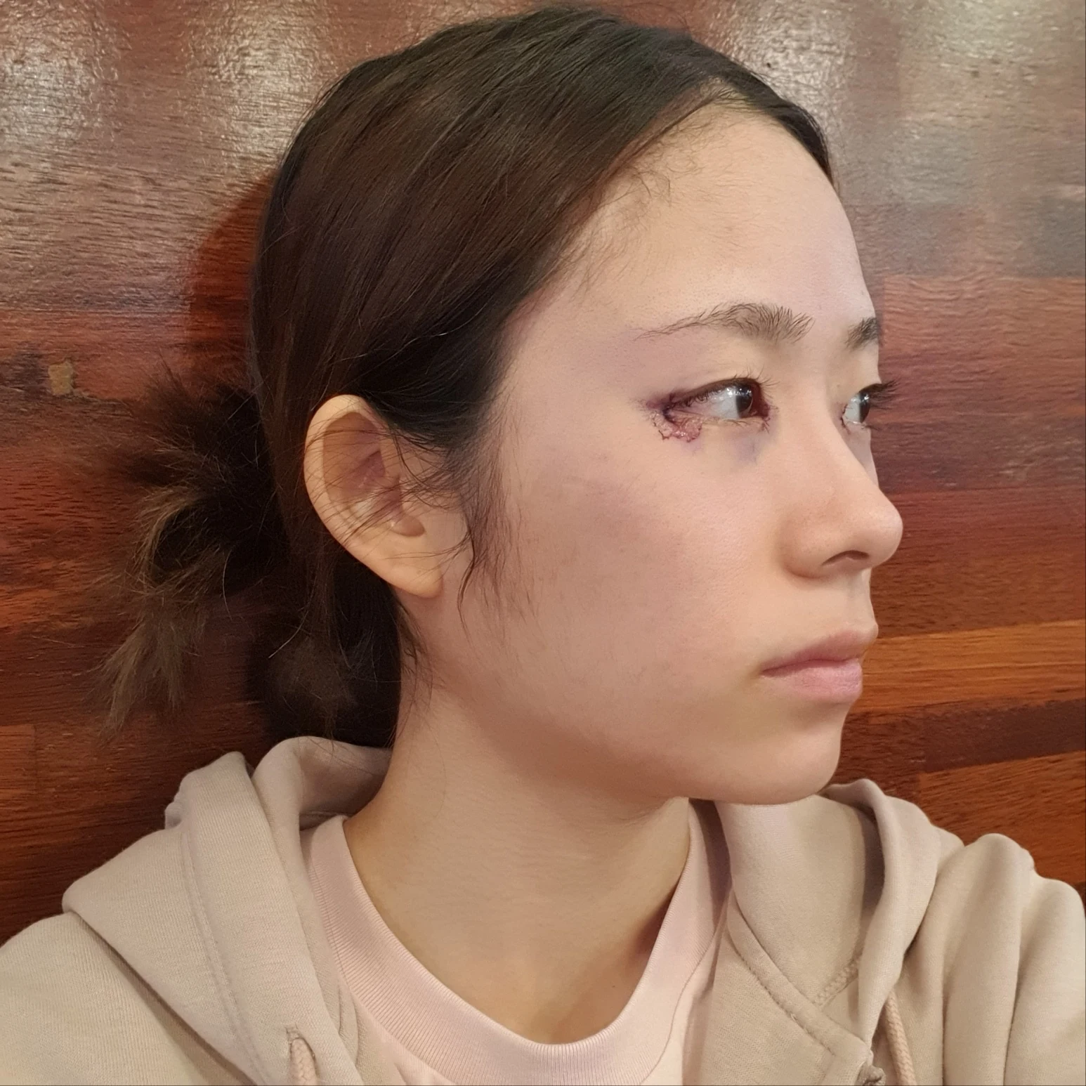 Inner and outer eye-corner surgery: recovery through three months · Case 073 at Answer Plastic Surgery. Oblique view facing image right — surgery day, inner and outer eye-corner surgery at Answer Plastic Surgery (case 073).