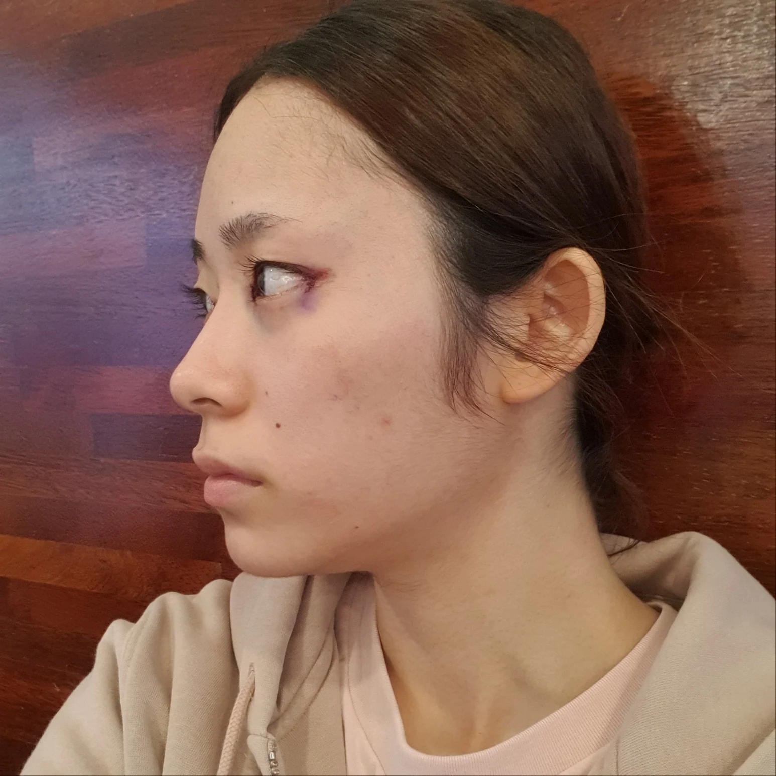 Inner and outer eye-corner surgery: recovery through three months · Case 073 at Answer Plastic Surgery. Oblique view facing image left — surgery day, inner and outer eye-corner surgery at Answer Plastic Surgery (case 073).