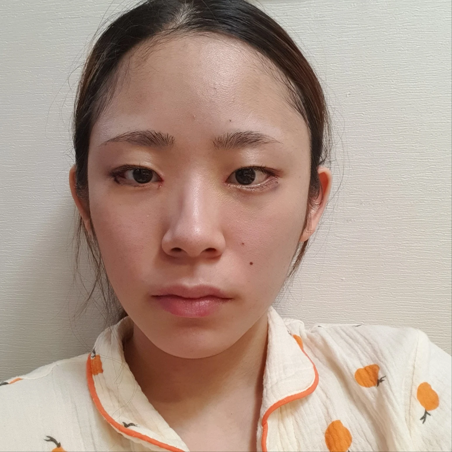 Inner and outer eye-corner surgery: recovery through three months · Case 073 at Answer Plastic Surgery. Front view — 1 week after surgery, inner and outer eye-corner surgery at Answer Plastic Surgery (case 073).
