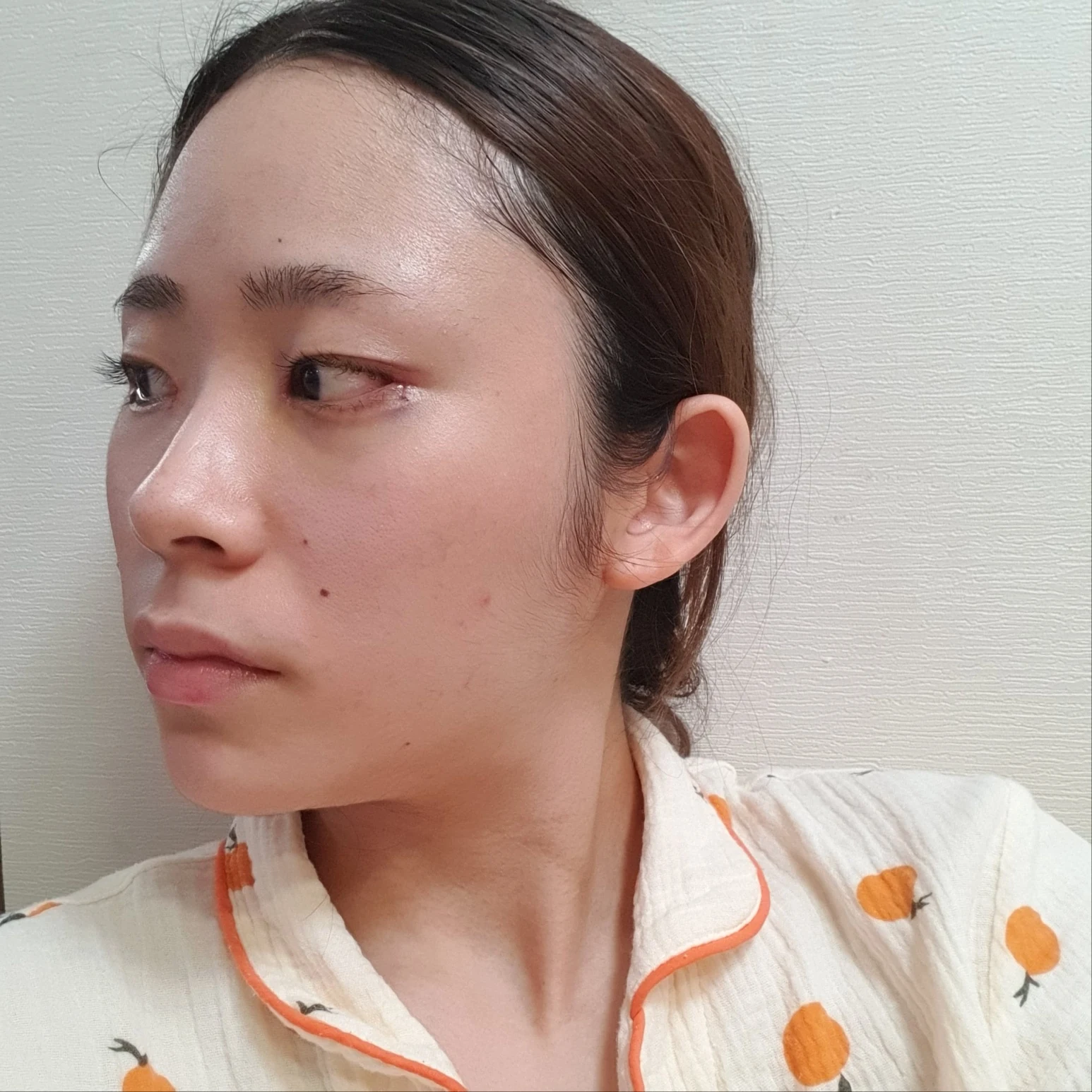 Inner and outer eye-corner surgery: recovery through three months · Case 073 at Answer Plastic Surgery. Oblique view facing image left — 1 week after surgery, inner and outer eye-corner surgery at Answer Plastic Surgery (case 073).