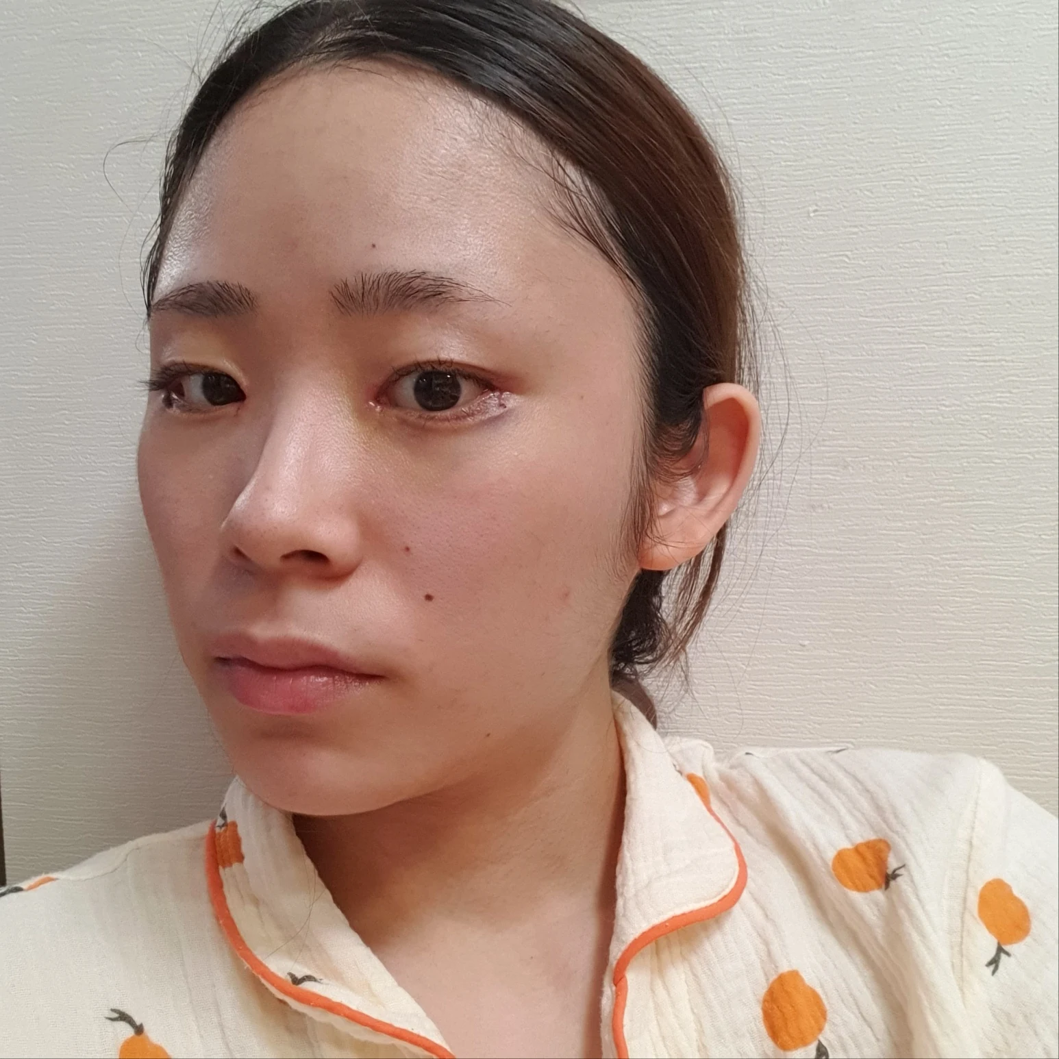 Inner and outer eye-corner surgery: recovery through three months · Case 073 at Answer Plastic Surgery. Oblique view — 1 week after surgery, inner and outer eye-corner surgery at Answer Plastic Surgery (case 073).