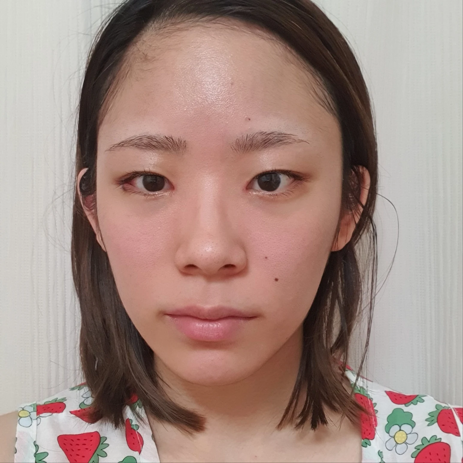 Inner and outer eye-corner surgery: recovery through three months · Case 073 at Answer Plastic Surgery. Front view — 2 weeks after surgery, inner and outer eye-corner surgery at Answer Plastic Surgery (case 073).