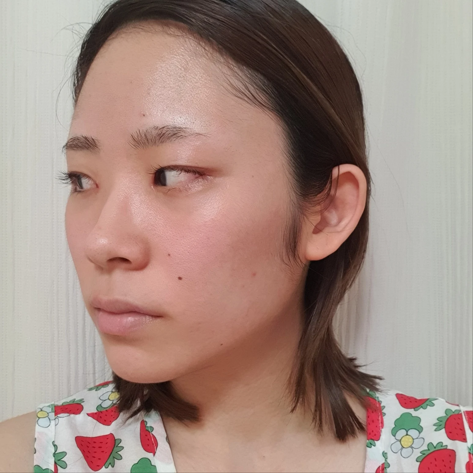 Inner and outer eye-corner surgery: recovery through three months · Case 073 at Answer Plastic Surgery. Oblique view facing image left — 2 weeks after surgery, inner and outer eye-corner surgery at Answer Plastic Surgery (case 073).