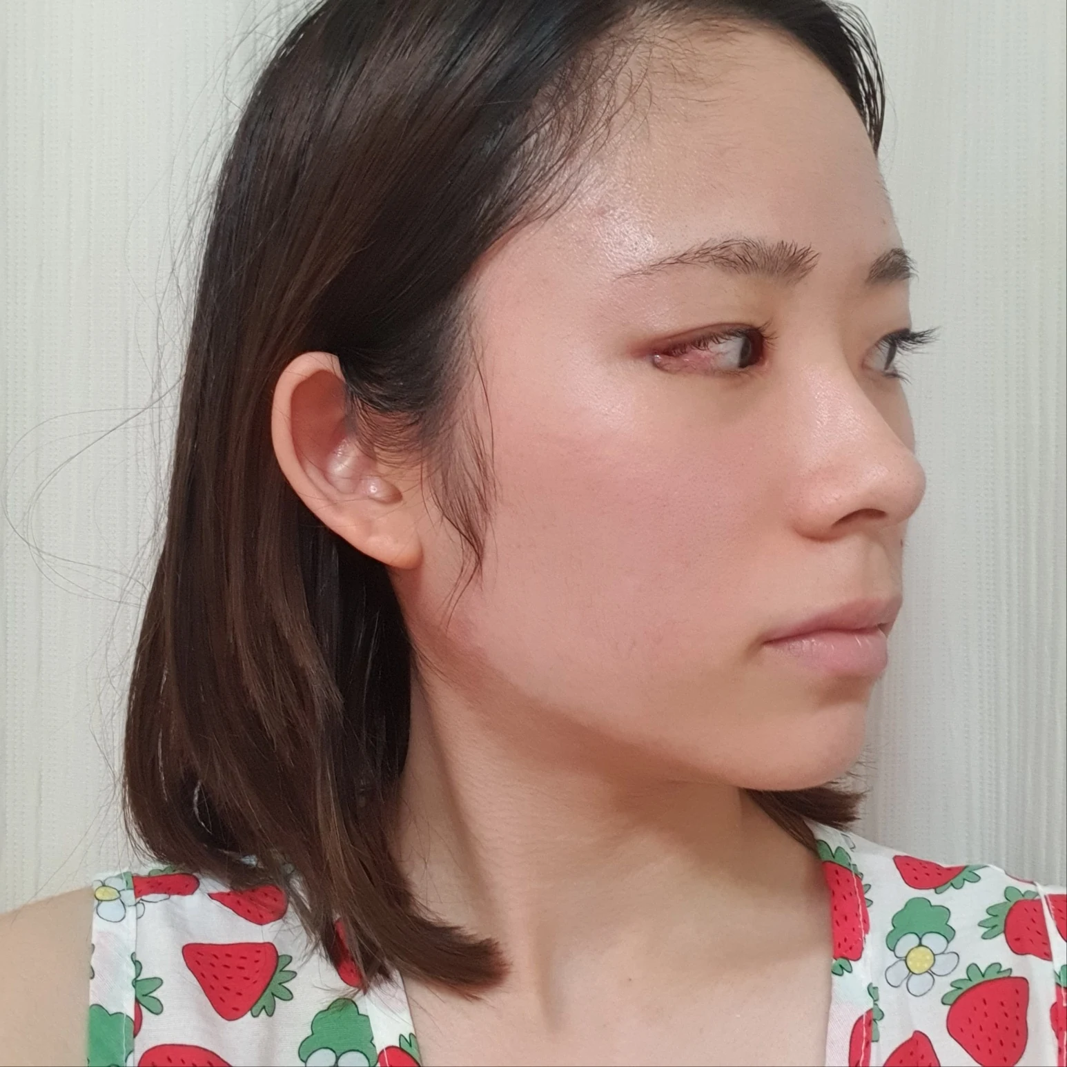 Inner and outer eye-corner surgery: recovery through three months · Case 073 at Answer Plastic Surgery. Oblique view facing image right — 2 weeks after surgery, inner and outer eye-corner surgery at Answer Plastic Surgery (case 073).