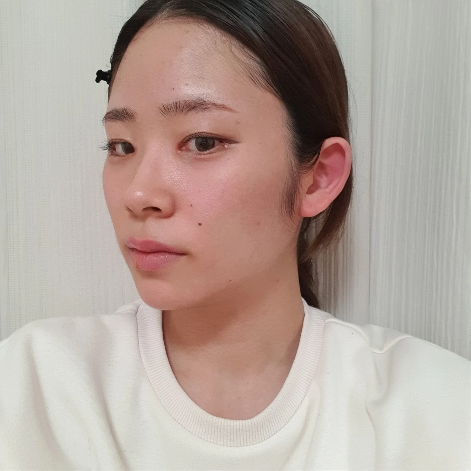 Inner and outer eye-corner surgery: recovery through three months · Case 073 at Answer Plastic Surgery. Near-front view — 1 month after surgery, inner and outer eye-corner surgery at Answer Plastic Surgery (case 073).