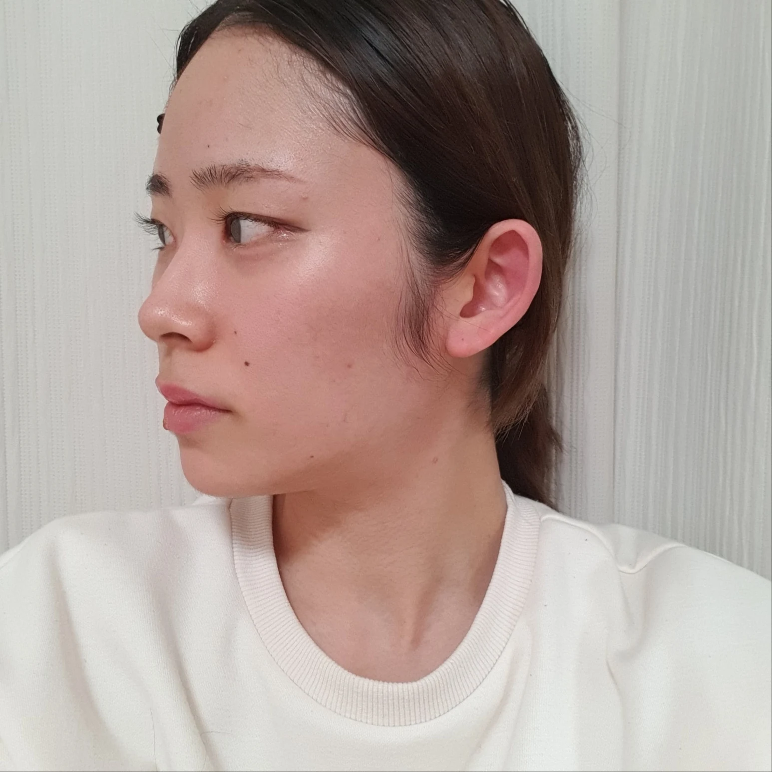 Inner and outer eye-corner surgery: recovery through three months · Case 073 at Answer Plastic Surgery. Oblique view facing image left — 1 month after surgery, inner and outer eye-corner surgery at Answer Plastic Surgery (case 073).