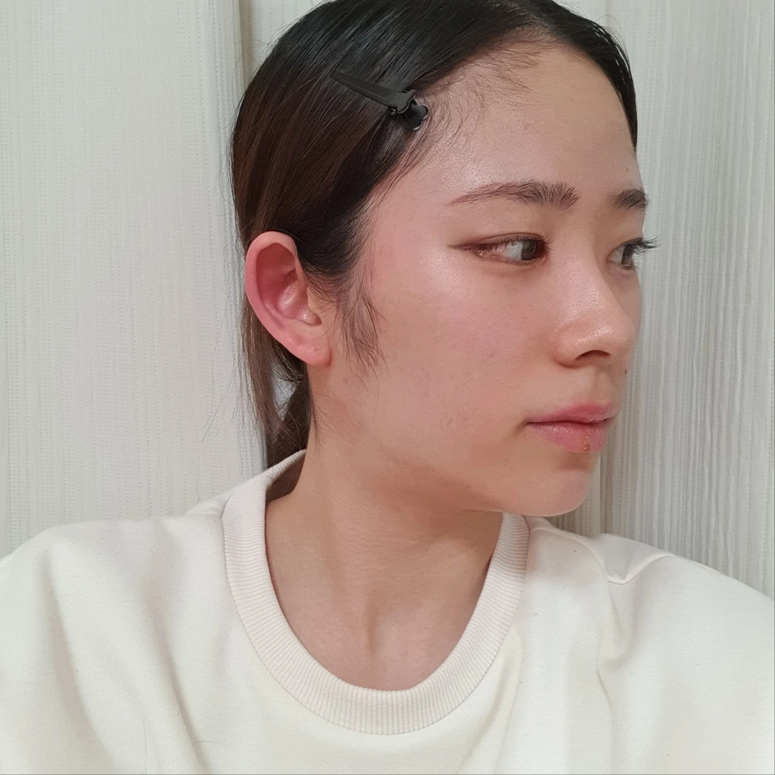 Inner and outer eye-corner surgery: recovery through three months · Case 073 at Answer Plastic Surgery. Oblique view facing image right — 1 month after surgery, inner and outer eye-corner surgery at Answer Plastic Surgery (case 073).