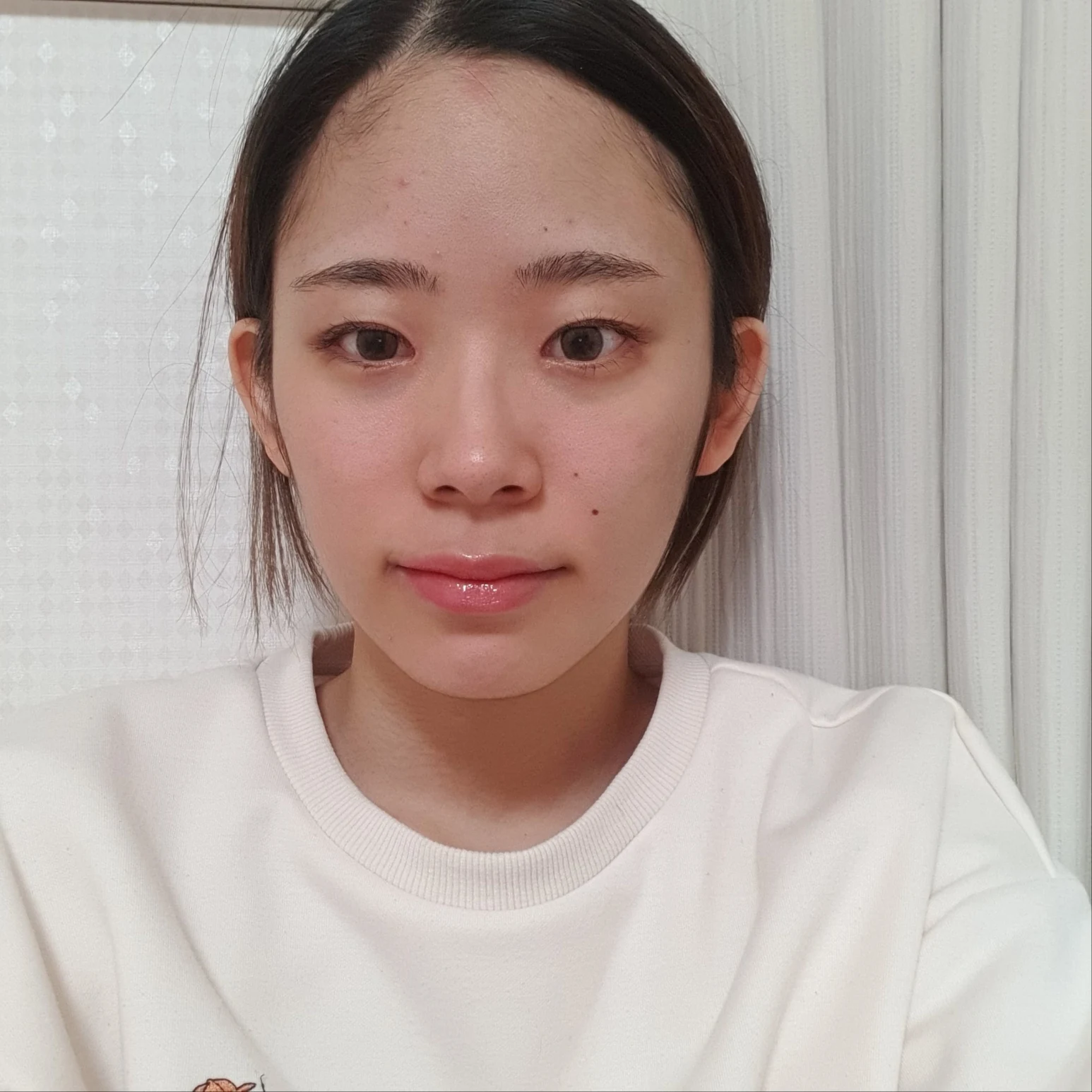 Inner and outer eye-corner surgery: recovery through three months · Case 073 at Answer Plastic Surgery. Front view — 2 months after surgery, inner and outer eye-corner surgery at Answer Plastic Surgery (case 073).