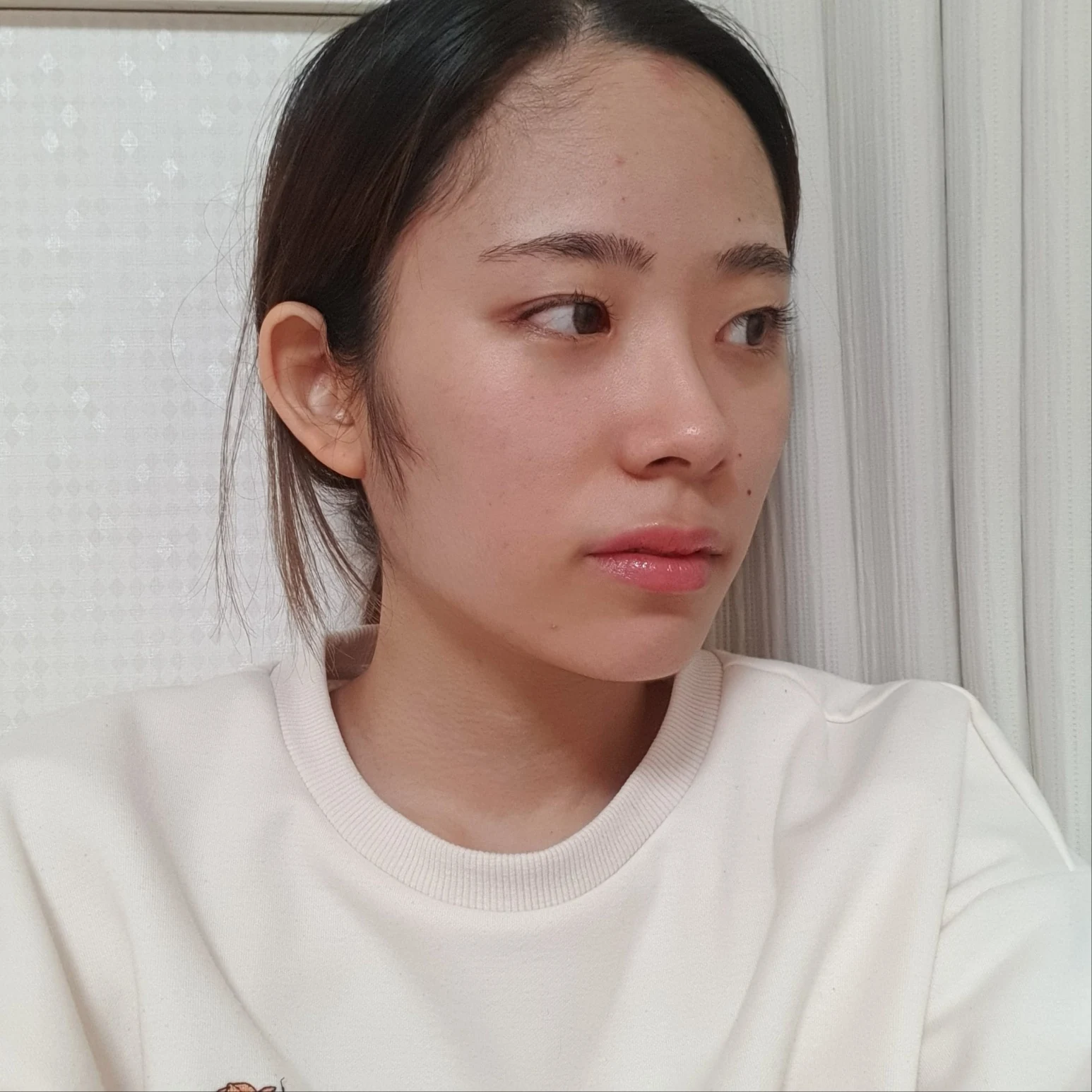 Inner and outer eye-corner surgery: recovery through three months · Case 073 at Answer Plastic Surgery. Oblique view facing image right — 2 months after surgery, inner and outer eye-corner surgery at Answer Plastic Surgery (case 073).
