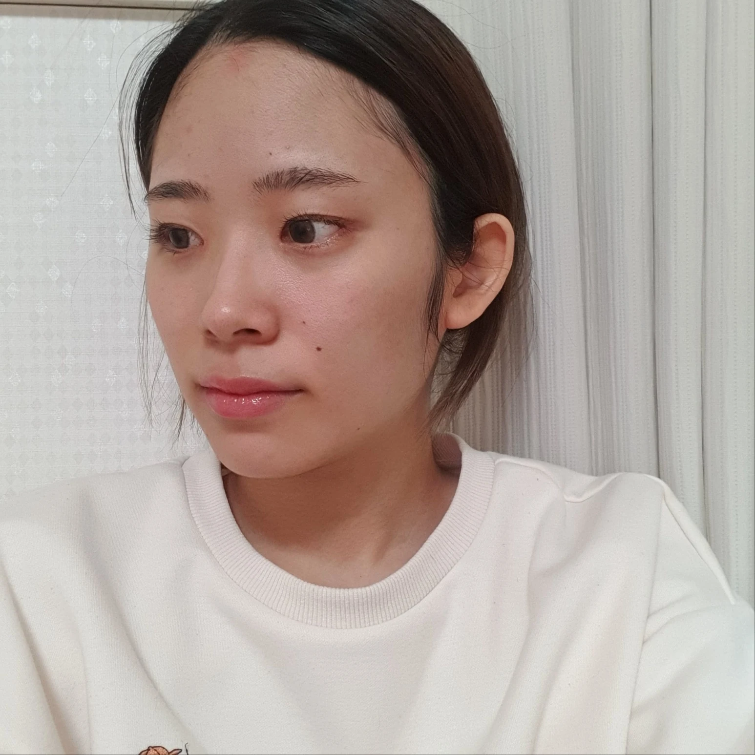 Inner and outer eye-corner surgery: recovery through three months · Case 073 at Answer Plastic Surgery. Oblique view facing image left — 2 months after surgery, inner and outer eye-corner surgery at Answer Plastic Surgery (case 073).
