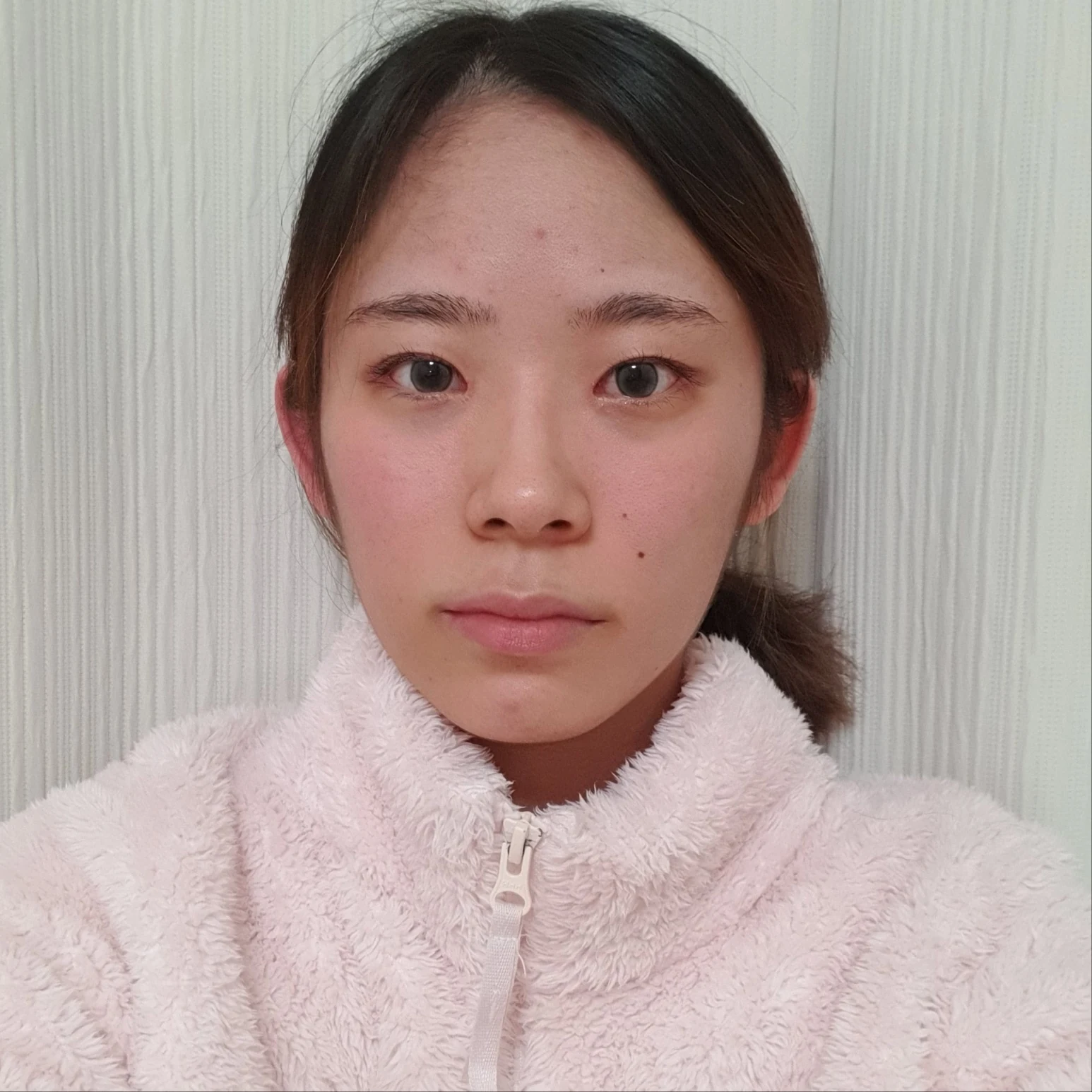 Inner and outer eye-corner surgery: recovery through three months · Case 073 at Answer Plastic Surgery. Front view — 3 months after surgery, inner and outer eye-corner surgery at Answer Plastic Surgery (case 073).