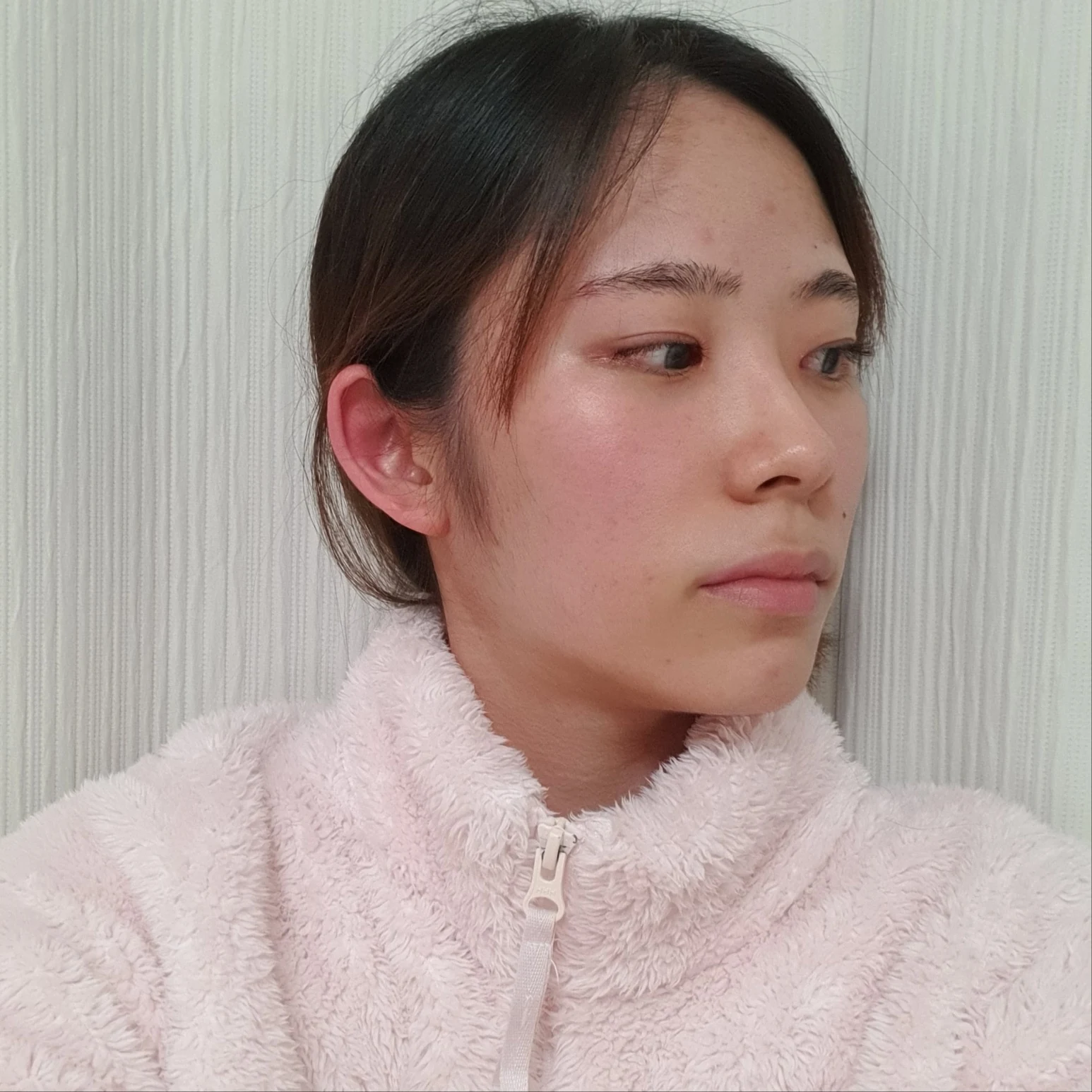 Inner and outer eye-corner surgery: recovery through three months · Case 073 at Answer Plastic Surgery. Oblique view facing image right — 3 months after surgery, inner and outer eye-corner surgery at Answer Plastic Surgery (case 073).