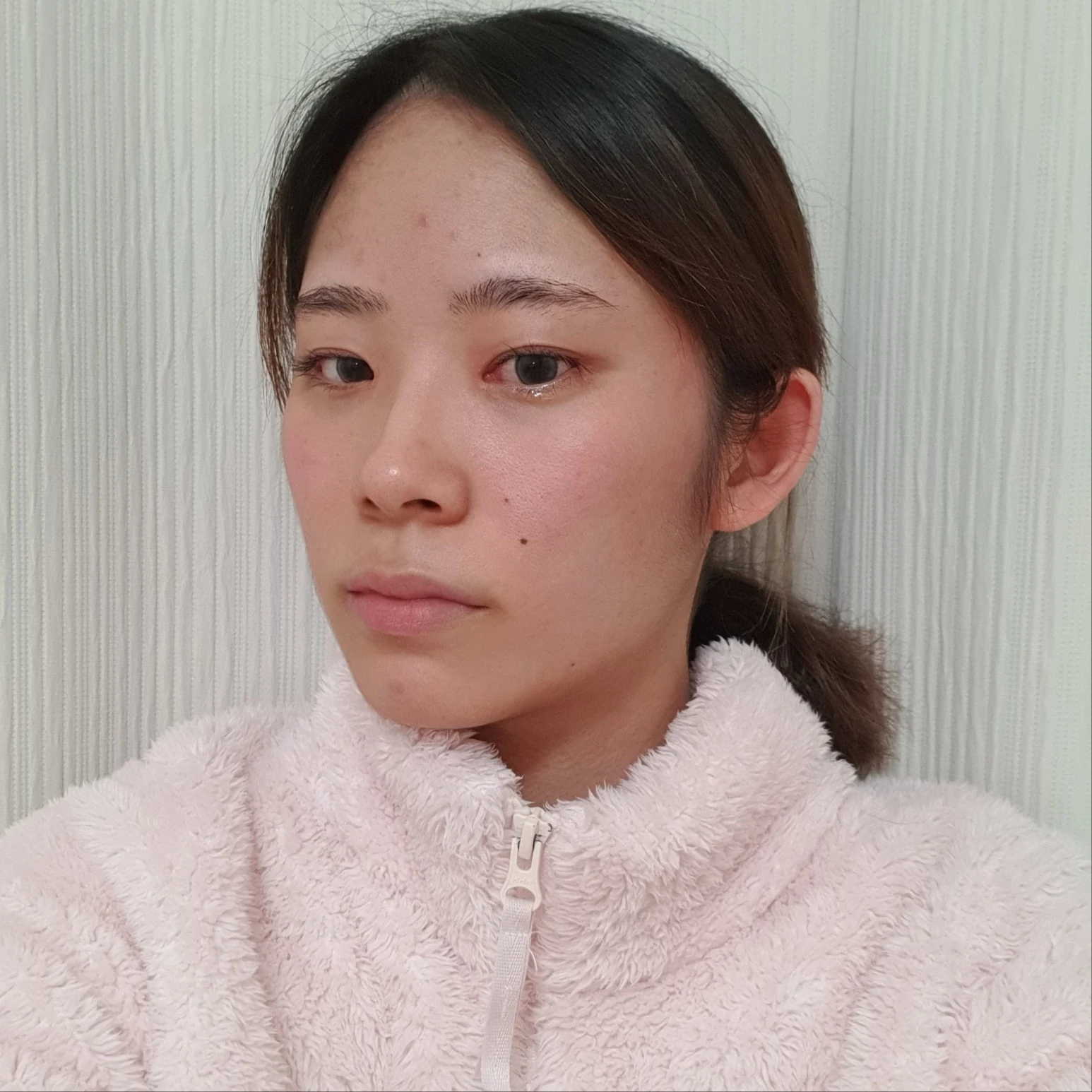 Inner and outer eye-corner surgery: recovery through three months · Case 073 at Answer Plastic Surgery. Oblique view facing image left — 3 months after surgery, inner and outer eye-corner surgery at Answer Plastic Surgery (case 073).