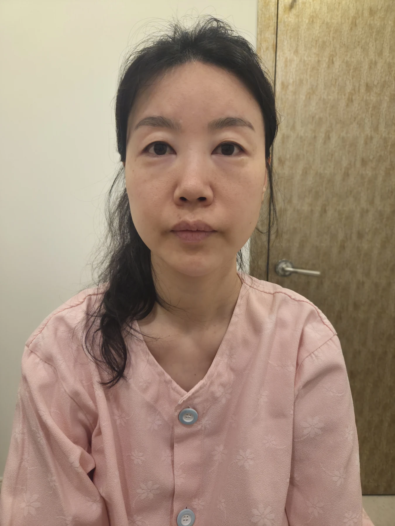 Double-eyelid and inner eye-corner surgery: a three-month photo diary · Case 074 at Answer Plastic Surgery. Front view — before surgery, double-eyelid and inner eye-corner surgery at Answer Plastic Surgery (case 074).