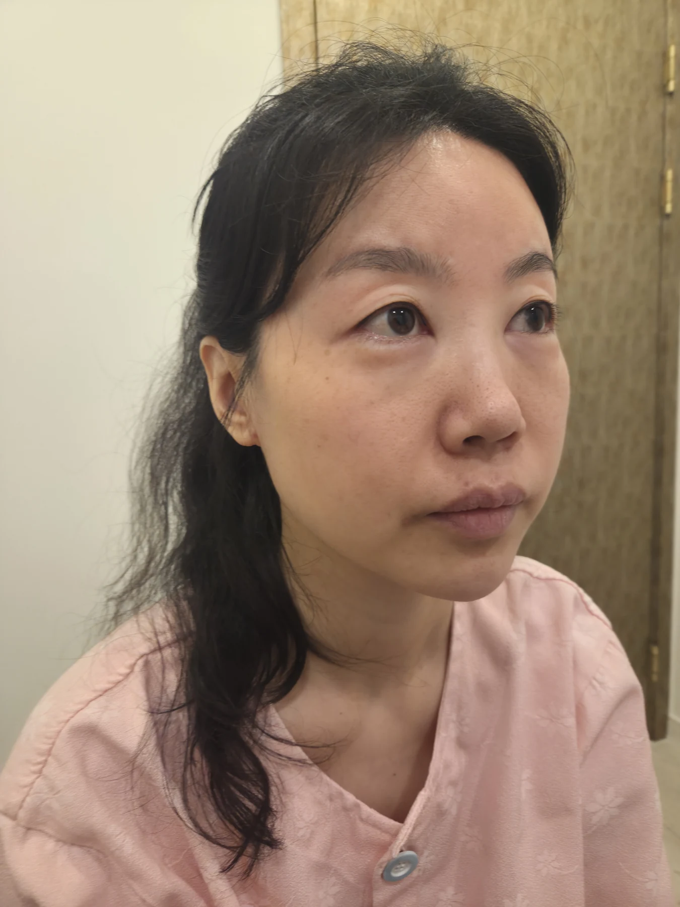 Double-eyelid and inner eye-corner surgery: a three-month photo diary · Case 074 at Answer Plastic Surgery. Oblique view facing image right — before surgery, double-eyelid and inner eye-corner surgery at Answer Plastic Surgery (case 074).