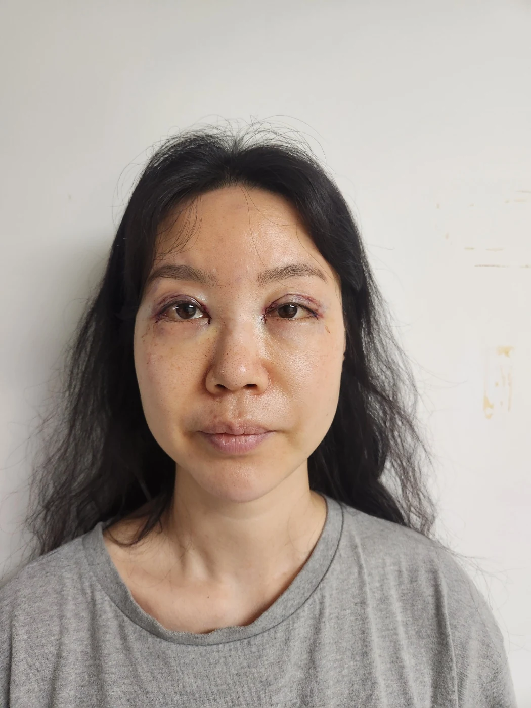 Double-eyelid and inner eye-corner surgery: a three-month photo diary · Case 074 at Answer Plastic Surgery. Front view — surgery day, double-eyelid and inner eye-corner surgery at Answer Plastic Surgery (case 074).