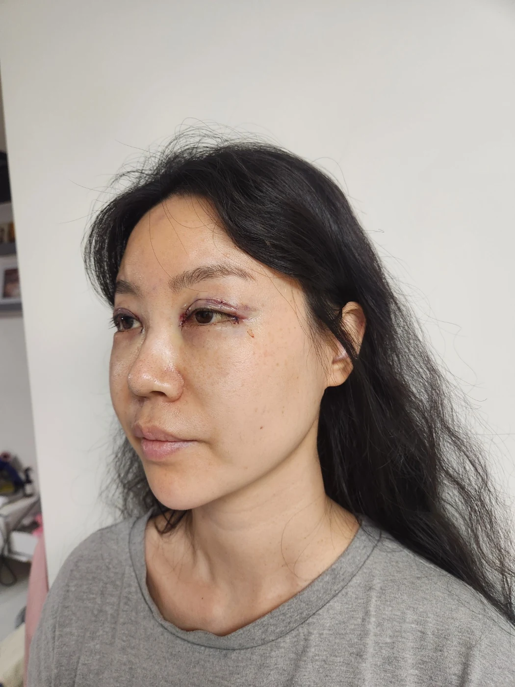 Double-eyelid and inner eye-corner surgery: a three-month photo diary · Case 074 at Answer Plastic Surgery. Oblique view facing image left — surgery day, double-eyelid and inner eye-corner surgery at Answer Plastic Surgery (case 074).