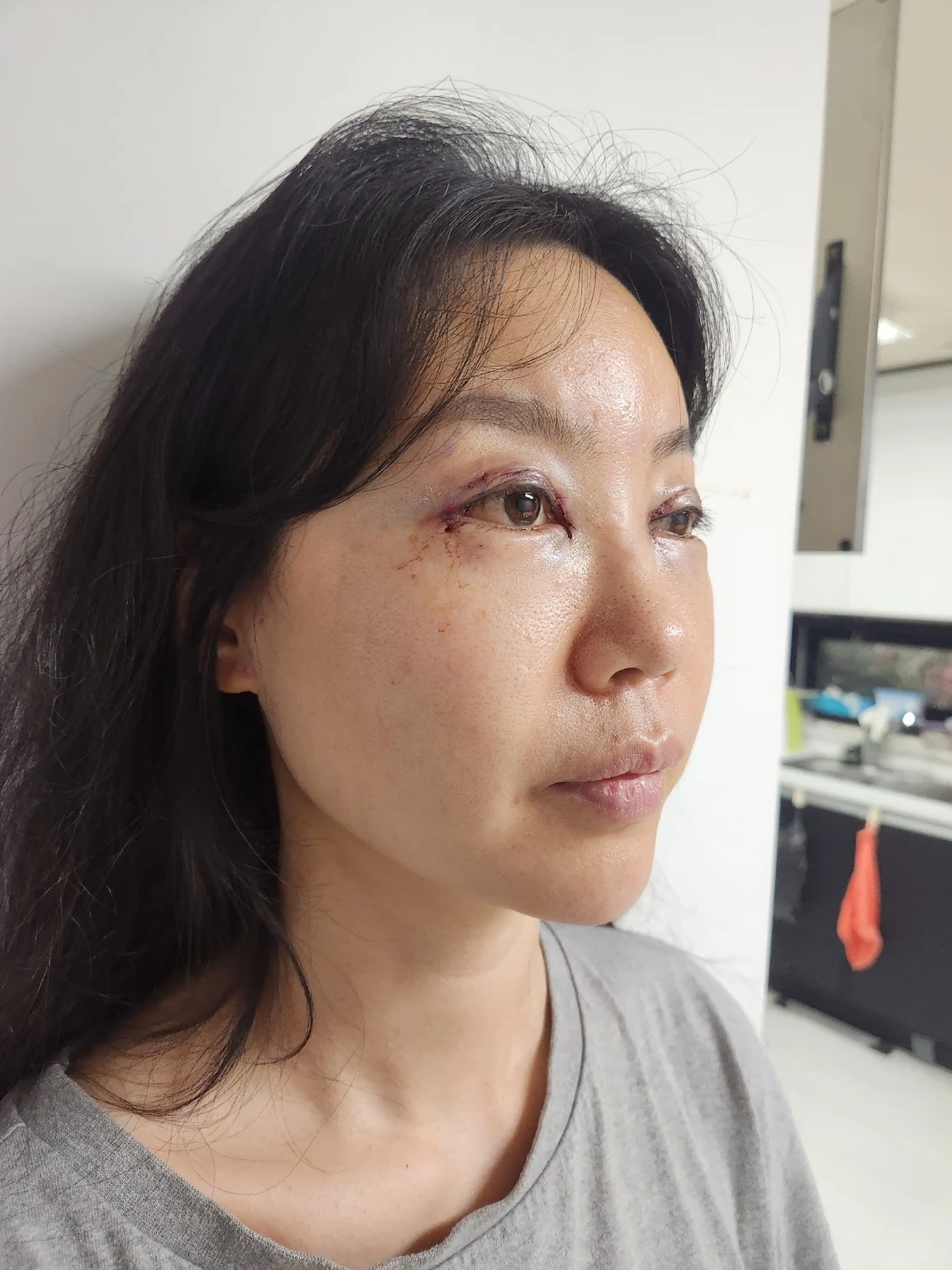 Double-eyelid and inner eye-corner surgery: a three-month photo diary · Case 074 at Answer Plastic Surgery. Oblique view facing image right — surgery day, double-eyelid and inner eye-corner surgery at Answer Plastic Surgery (case 074).