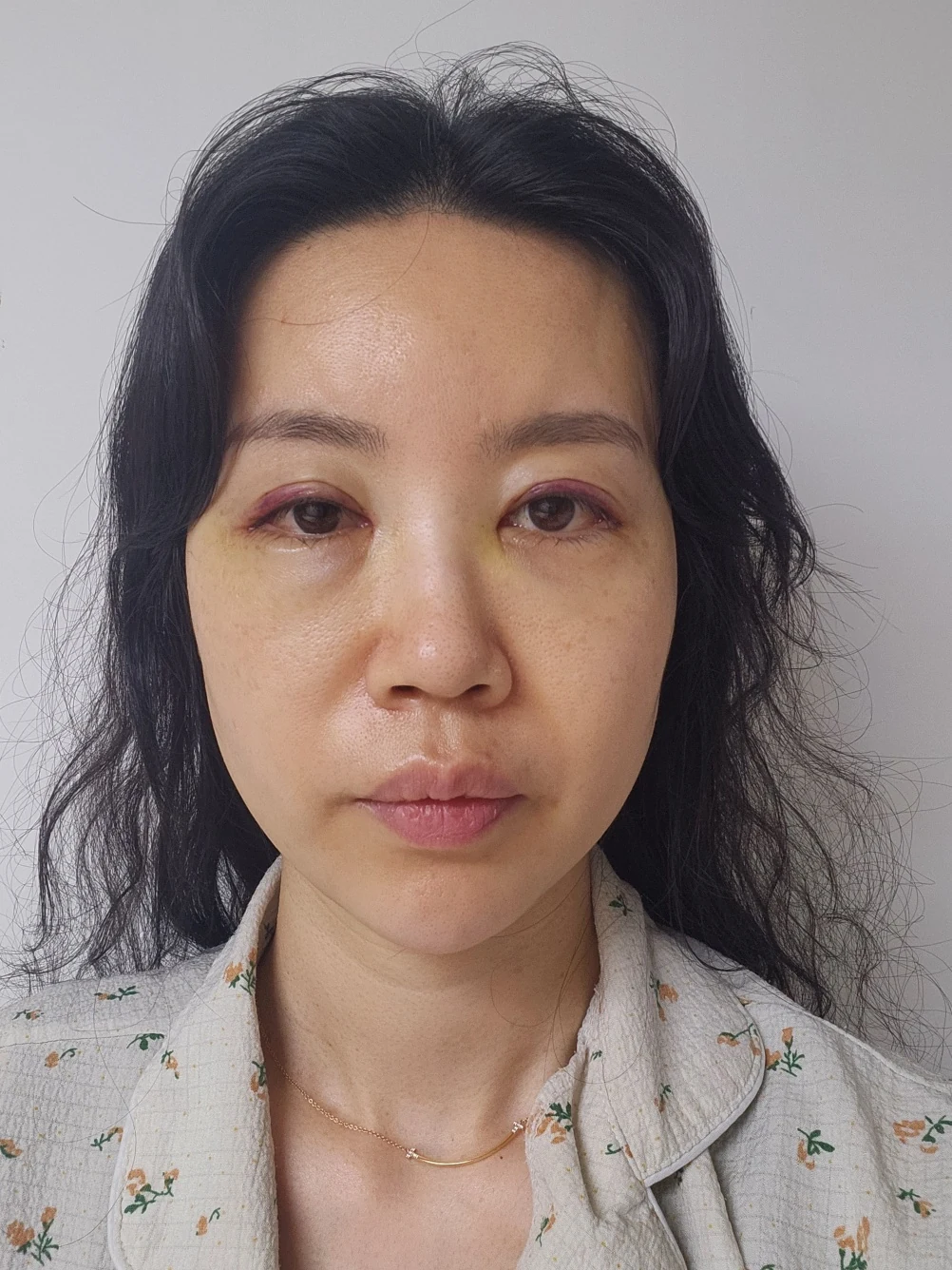 Double-eyelid and inner eye-corner surgery: a three-month photo diary · Case 074 at Answer Plastic Surgery. Front view — 1 week after surgery, double-eyelid and inner eye-corner surgery at Answer Plastic Surgery (case 074).