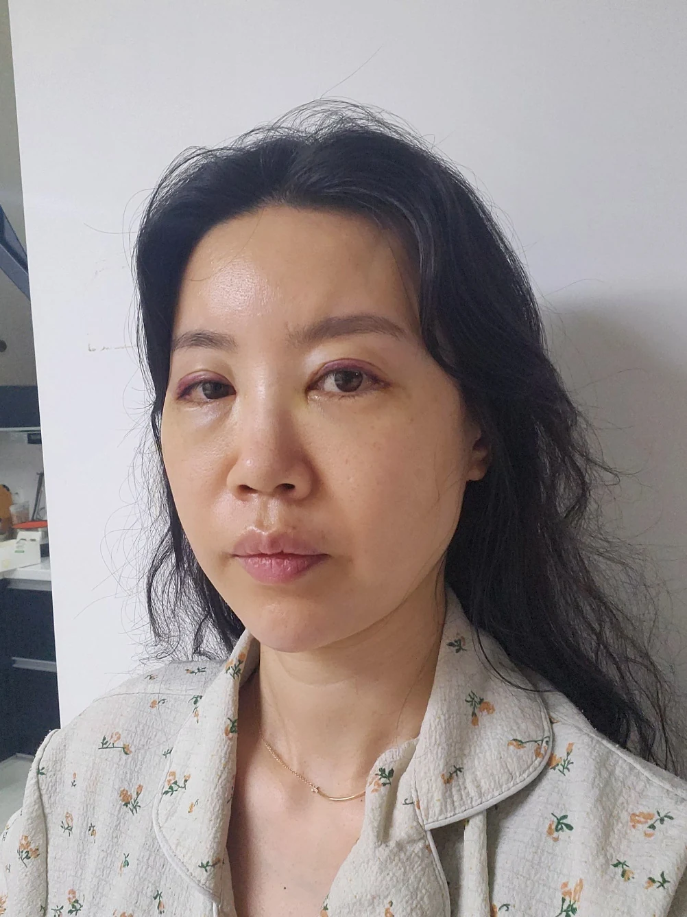 Double-eyelid and inner eye-corner surgery: a three-month photo diary · Case 074 at Answer Plastic Surgery. Oblique view facing image left — 1 week after surgery, double-eyelid and inner eye-corner surgery at Answer Plastic Surgery (case 074).