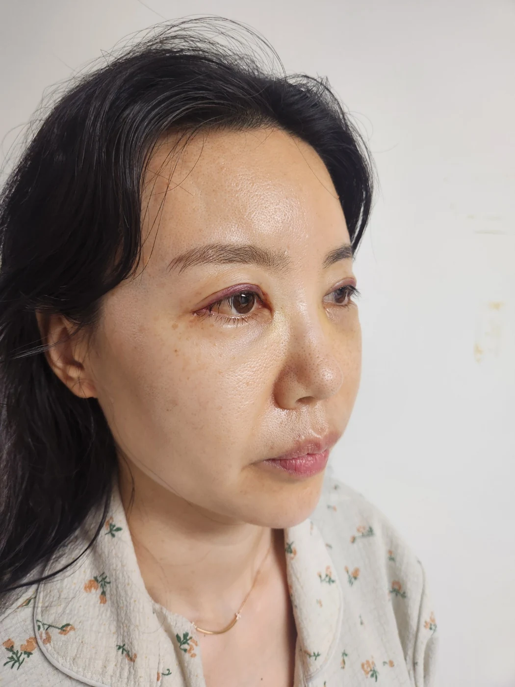 Double-eyelid and inner eye-corner surgery: a three-month photo diary · Case 074 at Answer Plastic Surgery. Oblique view facing image right — 1 week after surgery, double-eyelid and inner eye-corner surgery at Answer Plastic Surgery (case 074).