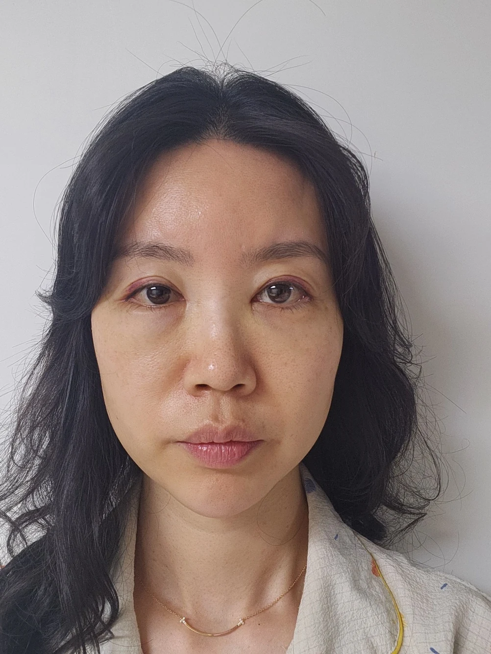 Double-eyelid and inner eye-corner surgery: a three-month photo diary · Case 074 at Answer Plastic Surgery. Front view — 2 weeks after surgery, double-eyelid and inner eye-corner surgery at Answer Plastic Surgery (case 074).