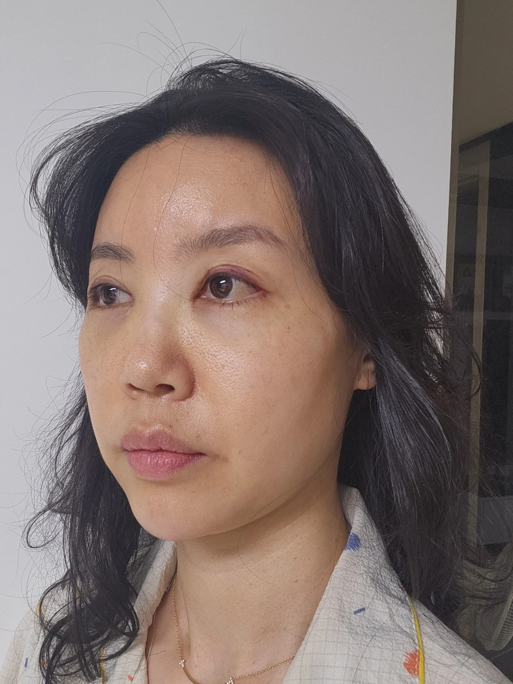 Double-eyelid and inner eye-corner surgery: a three-month photo diary · Case 074 at Answer Plastic Surgery. Oblique view facing image left — 2 weeks after surgery, double-eyelid and inner eye-corner surgery at Answer Plastic Surgery (case 074).
