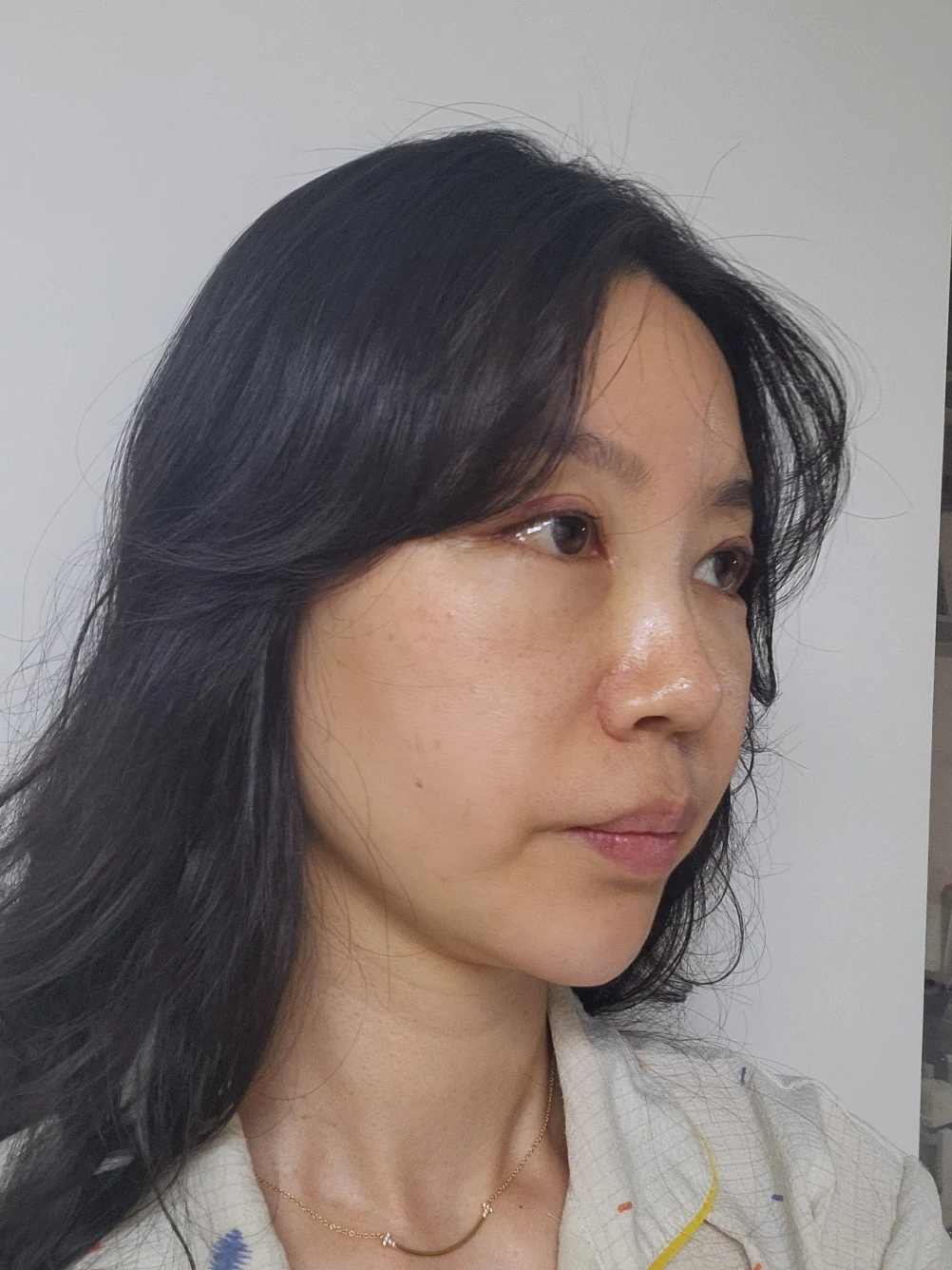 Double-eyelid and inner eye-corner surgery: a three-month photo diary · Case 074 at Answer Plastic Surgery. Oblique view facing image right — 2 weeks after surgery, double-eyelid and inner eye-corner surgery at Answer Plastic Surgery (case 074).