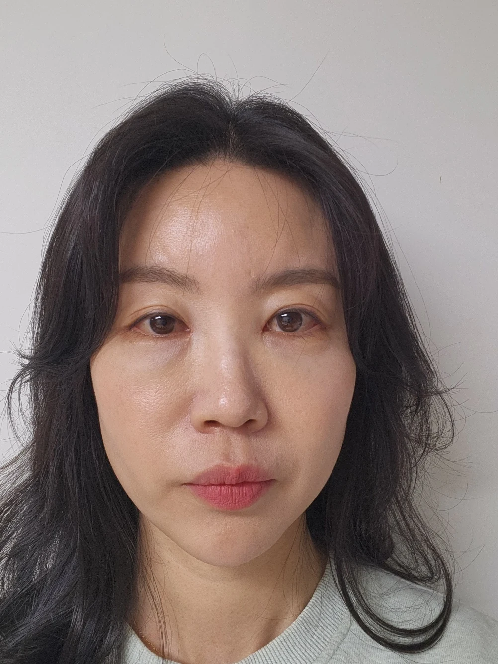 Double-eyelid and inner eye-corner surgery: a three-month photo diary · Case 074 at Answer Plastic Surgery. Front view — 1 month after surgery, double-eyelid and inner eye-corner surgery at Answer Plastic Surgery (case 074).