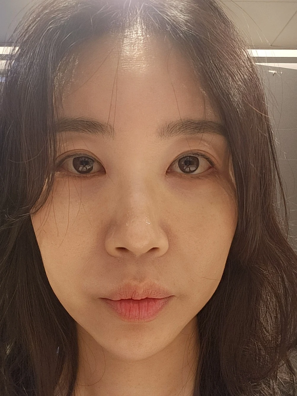 Double-eyelid and inner eye-corner surgery: a three-month photo diary · Case 074 at Answer Plastic Surgery. Near-front view — 2 months after surgery, double-eyelid and inner eye-corner surgery at Answer Plastic Surgery (case 074).