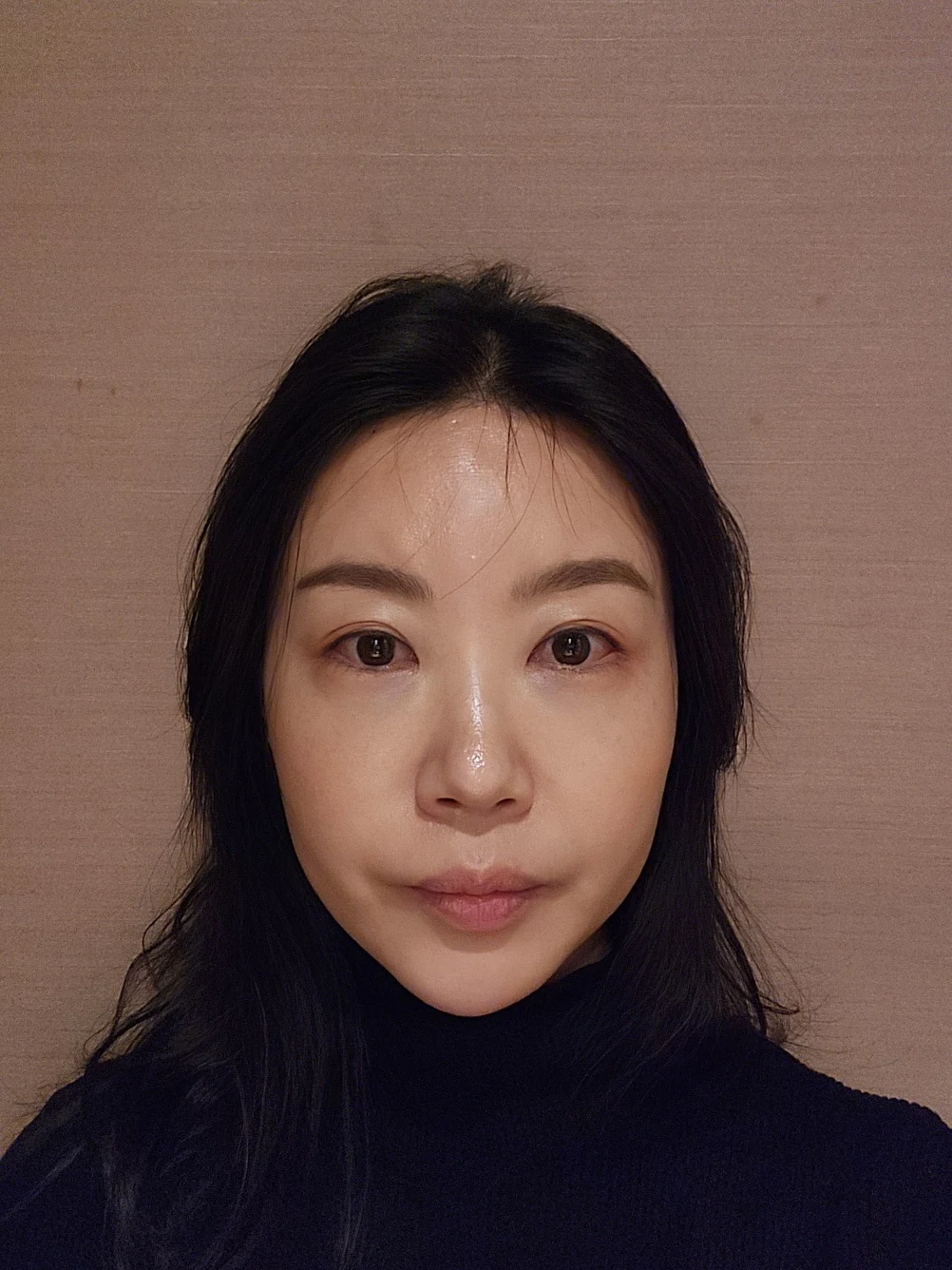 Double-eyelid and inner eye-corner surgery: a three-month photo diary · Case 074 at Answer Plastic Surgery. Front view — 3 months after surgery, double-eyelid and inner eye-corner surgery at Answer Plastic Surgery (case 074).