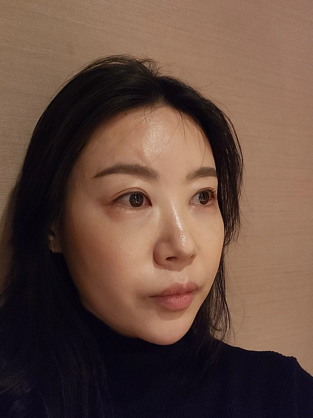 Double-eyelid and inner eye-corner surgery: a three-month photo diary · Case 074 at Answer Plastic Surgery. Oblique view facing image right — 3 months after surgery, double-eyelid and inner eye-corner surgery at Answer Plastic Surgery (case 074).