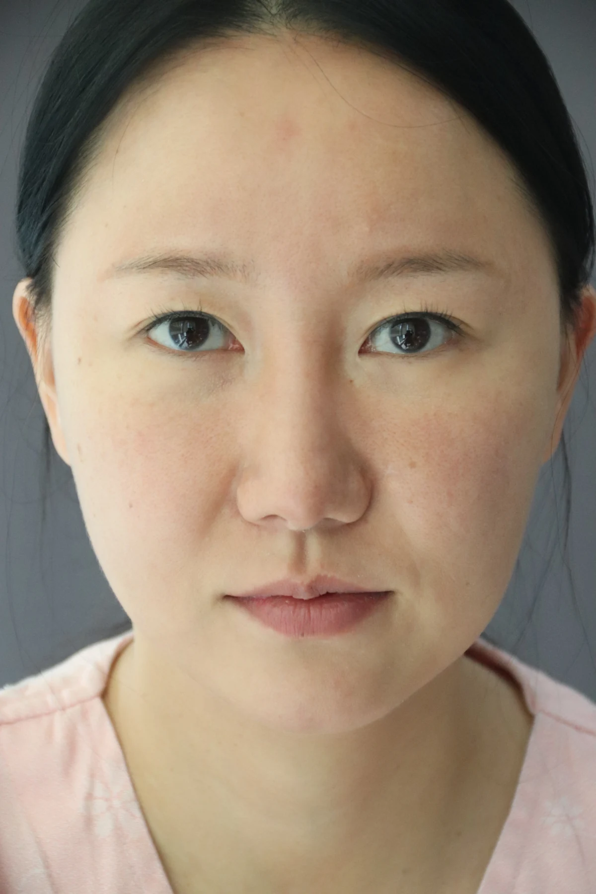 Eye-area comparison from before treatment to one month · Case 079 at Answer Plastic Surgery. Front view — before, eye-area comparison from before treatment to one month at Answer Plastic Surgery (case 079).